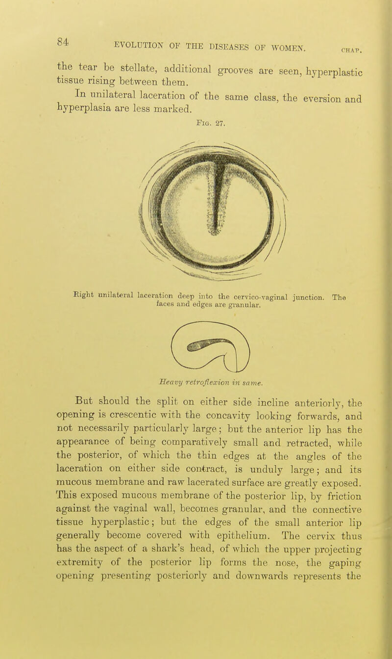 the tear be stellate, additional grooves are seen, hyperplastic tissue rising between them. In unilateral laceration of the same class, the eversion and hyperplasia are less marked. Fig. 27. Eight unilateral laceration deep into the cervico-vaginal junction. The faces and edges are granular. Heavy retroflexion in same. But should the split on either side incline anteriorly, the opening is crescentic with the concavity looking forwards, and not necessarily particularly large; but the anterior lip has the appearance of being comparatively small and retracted, while the posterior, of which the thin edges at the angles of the laceration on either side contract, is unduly large; and its mucous membrane and raw lacerated surface are greatly exposed. This exposed mucous membrane of the posterior lip, by friction against the vaginal wall, becomes granular, and the connective tissue hyperplastic; but the edges of the small anterior lip generally become covered with epithelium. The cervix thus has the aspect of a shark's head, of which the upper projecting extremity of the posterior lip forms the nose, the gaping opening presenting posteriorly and downwards represents the