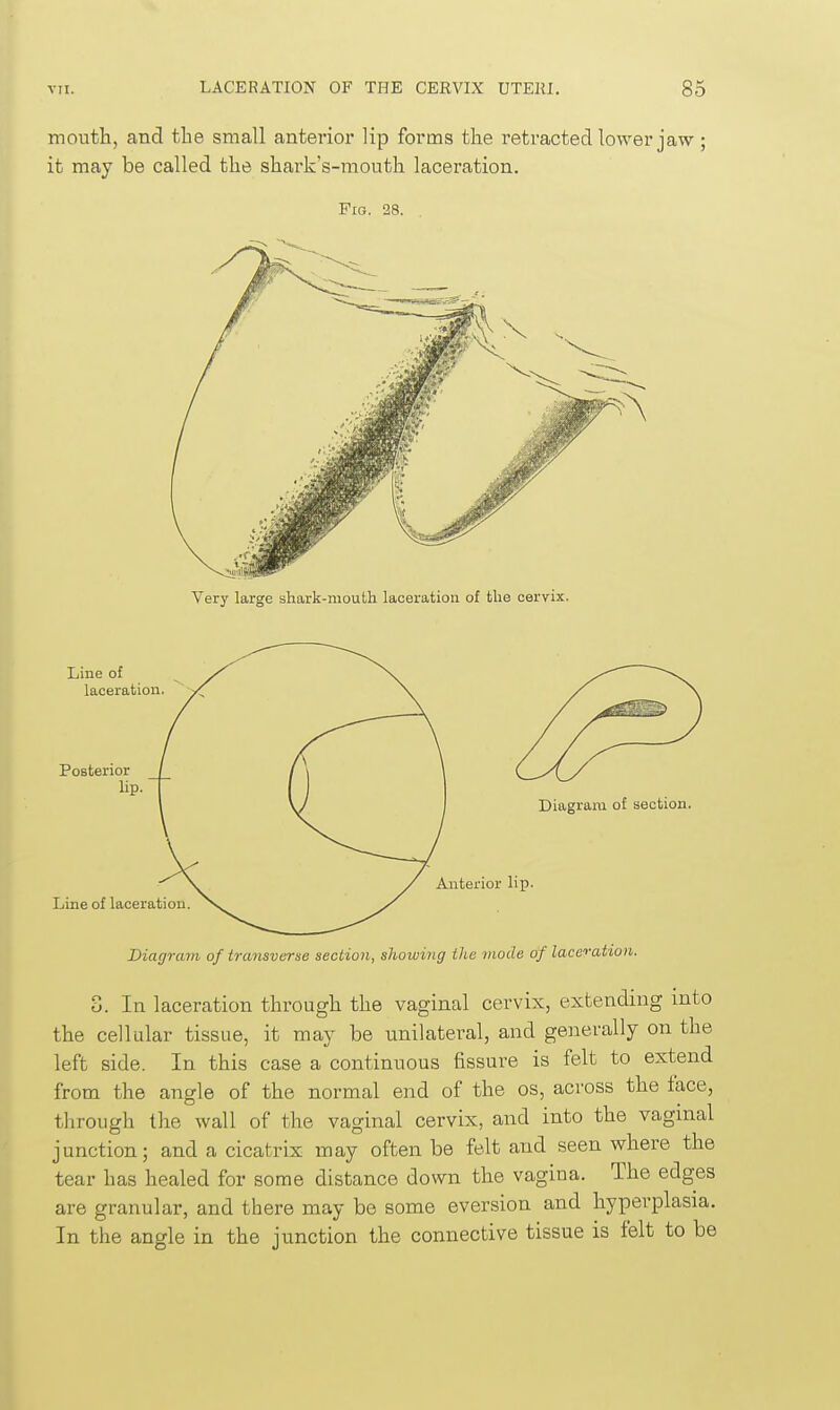 mouth, and the small anterior lip forms the retracted lower jaw ; it may be called the shark's-mouth laceration. Pig. 28. Line of laceration Posterior lip. Line of laceration. Diagram of section. Anterior lip. Diagram of transverse section, showing the mode of laceration. 3. In laceration through the vaginal cervix, extending into the cellular tissue, it may be unilateral, and generally on the left side. In this case a continuous fissure is felt to extend from the angle of the normal end of the os, across the face, through the wall of the vaginal cervix, and into the vaginal junction; and a cicatrix may often be felt and seen where the tear has healed for some distance down the vagina. The edges are granular, and there may be some eversion and hyperplasia. In the angle in the junction the connective tissue is felt to be