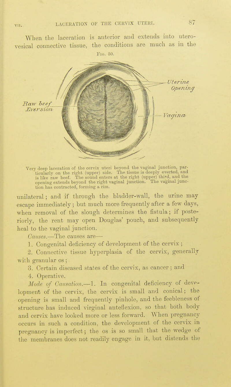 When the lacea'fitioii is autei'ior and extends into utero- vesical connective tissue, the conditions are much as in the Fig. 80. • VteTvne Opening Haw heef JEversion Va<jLUCV Very deep laceration of the cervix uteri beyond the vaginal junction, par- 'ticularly on the right (upper) side. The tissue is deeply everted, and is like raw beef. The sound enters at the right (upper) third, and the opening extends beyond the right vaginal junction. The vaginal junc- tion has contracted, forming a rim. unilateral; and if through the bladder-wall, the urine may- escape immediately ; but much more frequently after a few days, when removal of the slough detemnines the fistula; if poste- riorly, the rent may open Douglas' pouch, and subsequently heal to the vaginal junction. Causes.—The causes are— 1. Congenital deficiency of development of the cervix ; 2. Connective tissue hyperplasia of the cervix, generally with granular os; 3. Certain diseased states of the cervix, as cancer; and 4. Operative. Mode of Causation.—1. In congenital deficiency of deve- lopment of the cervix, the cervix is small and conical; the opening is small and frequently pinhole, and the feebleness of structure has induced virginal anteflexion, so that both body and cervix have looked more or less forward. When pregnancy occurs in such a condition, the development of the cervix in pregnancy is imperfect; the os is so small that the wedge of the membranes does not readily engage in it, but distends the