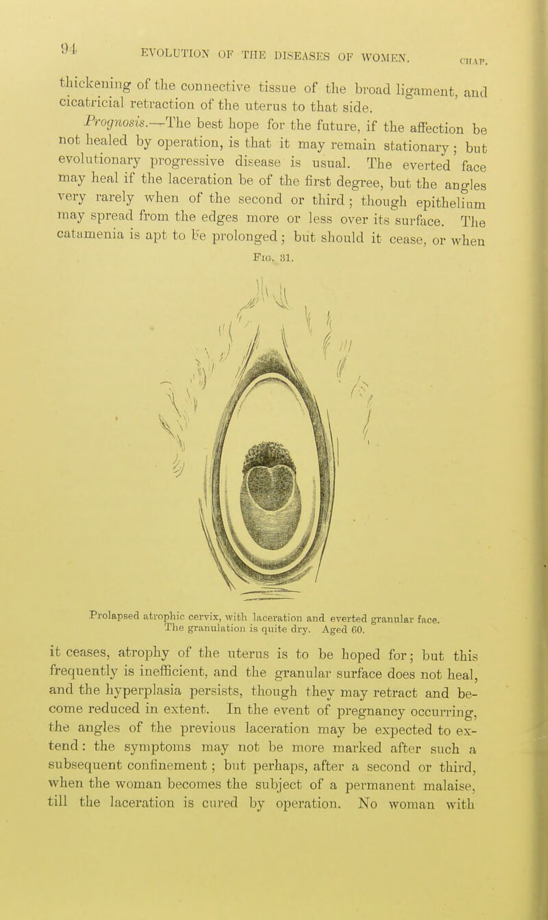 CHAP. thickening of the connective tissue of the broad ligament, and cicatricial retraction of the uterus to that side. Prognosis.-^The best hope for the future, if the affection be not healed by operation, is that it may remain stationary; but evolutionary progressive disease is usual. The everted'face may heal if the laceration be of the first degree, but the angles very rarely when of the second or third ; though epithelium may spread from the edges more or less over its surface. The catamenia is apt to be prolonged; but should it cease, or when Fio. 81. Prolapsed atrophic cervix, with laceration and everted granular face. The granulation is quite dry. Aged 60. it ceases, atrophy of the nterus is to be hoped for; but this frequently is inefficient, and the granular surface does not heal, and the hyperplasia persists, though they may retract and be- come reduced in extent. In the event of pregnancy occurring, the angles of the previous laceration may be expected to ex- tend: the symptoms may not be more marked after such a subsequent confinement; but perhaps, after a second or third, when the woman becomes the subject of a permanent malaise, till the laceration is cured by operation. No woman with