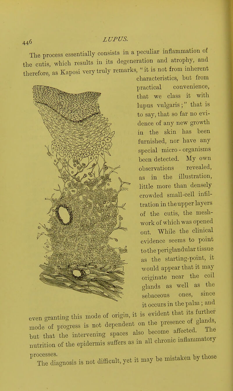 The process essentially consists in a peculiar inflammation of the cutis which results in its degeneration and atrophy, and therefore' as Kaposi very truly remarks, «it is not from inherent characteristics, but from practical convenience, that we class it with lupus vulgaris ; that is to say, that so far no evi- dence of any new growth in the skin has been furnished, nor have any special micro - organisms been detected. My own observations revealed, as in the illustration, little more than densely crowded small-cell infil- tration in the upper layers of the cutis, the mesh- work of which was Opened out. While the clinical evidence seems to point to the periglandular tissue as the starting-point, it would appear that it may originate near the coil o-lands as well as the sebaceous ones, since it occurs in the palm; and even granting this mode of origin, it is evident that its further .node of progress is not dependent on the hnt that the intervening spaees also become affected Ti e nutrition of the epidermis suffers as in all chrome mflammato.y ^diagnosis is not difficult, yet it may be mistaken by those