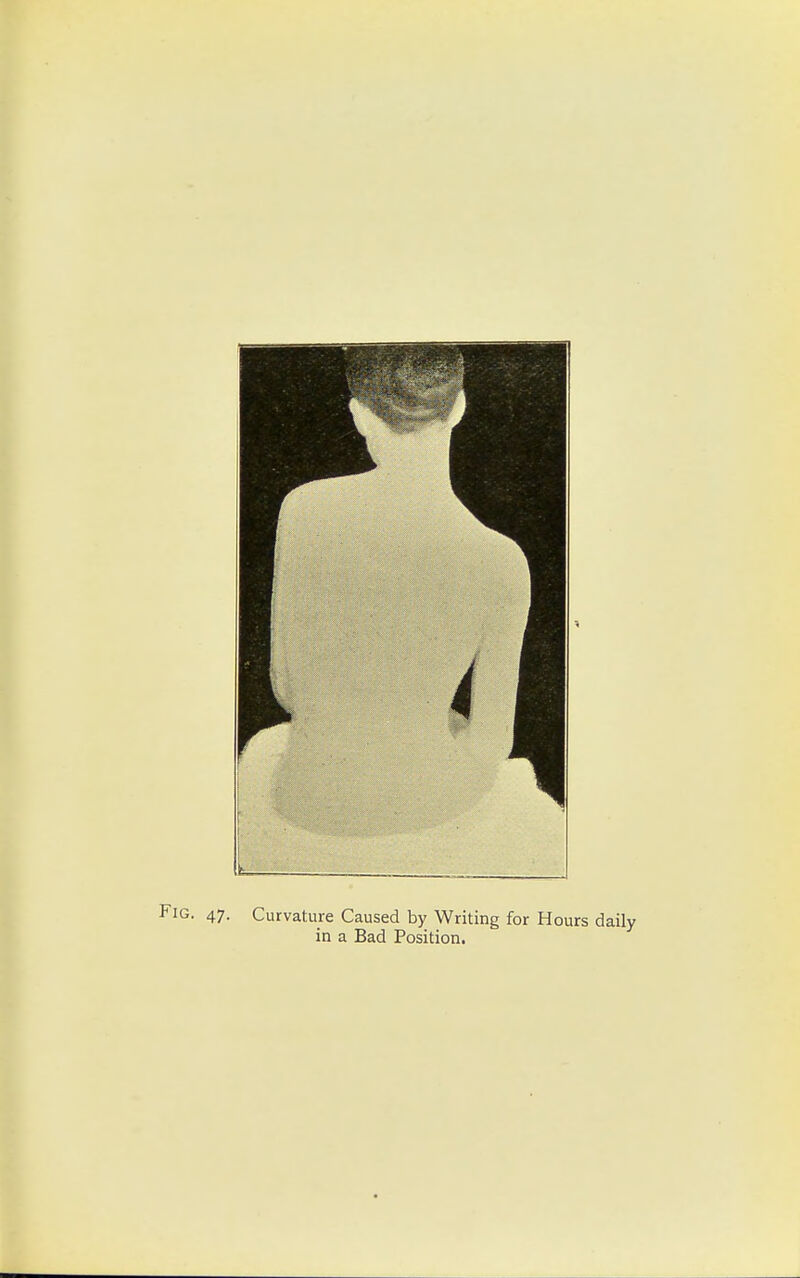 ■ 47- Curvature Caused by Writing for Hours daily in a Bad Position.