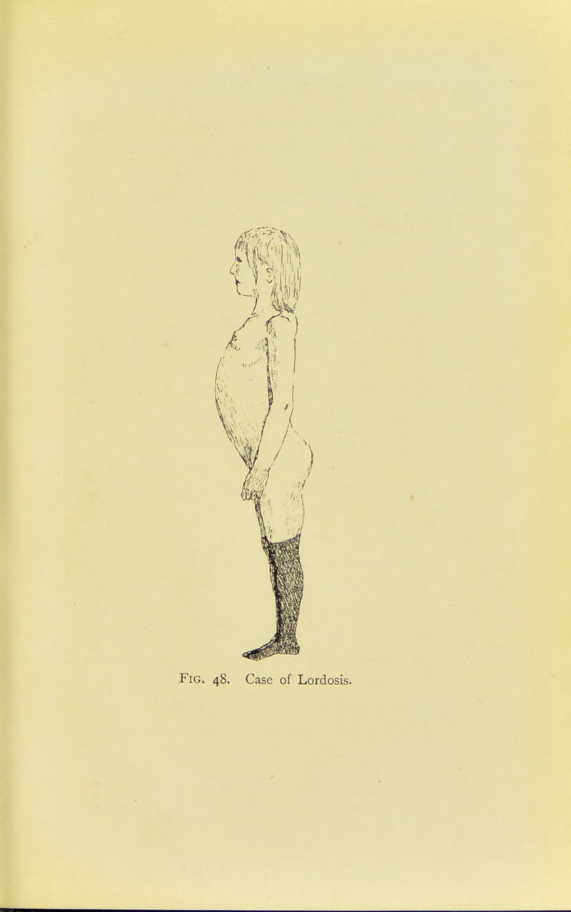 Fig. 48. Case of Lordosis.