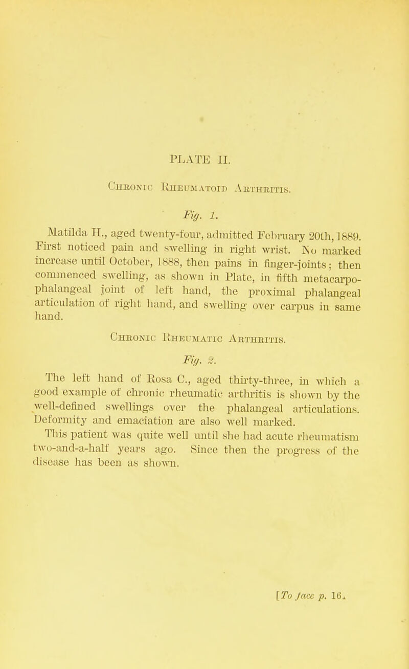 PLATE II. Chronic Rheumatoid Abthbitis. • Fig. 1. ^ Matilda H., aged twenty-four, admitted February 20th, 1889. First noticed pain and swelling in right wrist. ~t\u marked increase until October, 1888, then pains in finger-joints; then commenced swelling, as shown in Plate, in fifth metacarpo- phalangeal joint of left hand, the proximal phalangeal articulation of right hand, aud swelling over carpus in same hand. Chronic Rheumatic Arthritis. Fig. 2. The left hand of Rosa C, aged thirty-three, in which a good example of chronic; rheumatic arthritis is shown by the well-defined swellings over the phalangeal articulations. Deformity and emaciation are also well marked. This patient was quite well until she had acute rheumatism two-and-a-half years ago. Since then the progress of the disease has been as shown. [To face p. 16*
