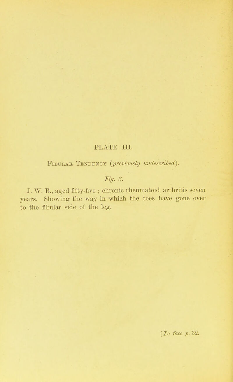 PLATE ELL Fibulae, Tendency (previously undescribed). Fig. 3. J. W. B., aged fifty-five ; chronic rheumatoid arthritis seven years. Showing the way in which the toes have gone over to the fibular side of the leg. [To face ]>. 82.