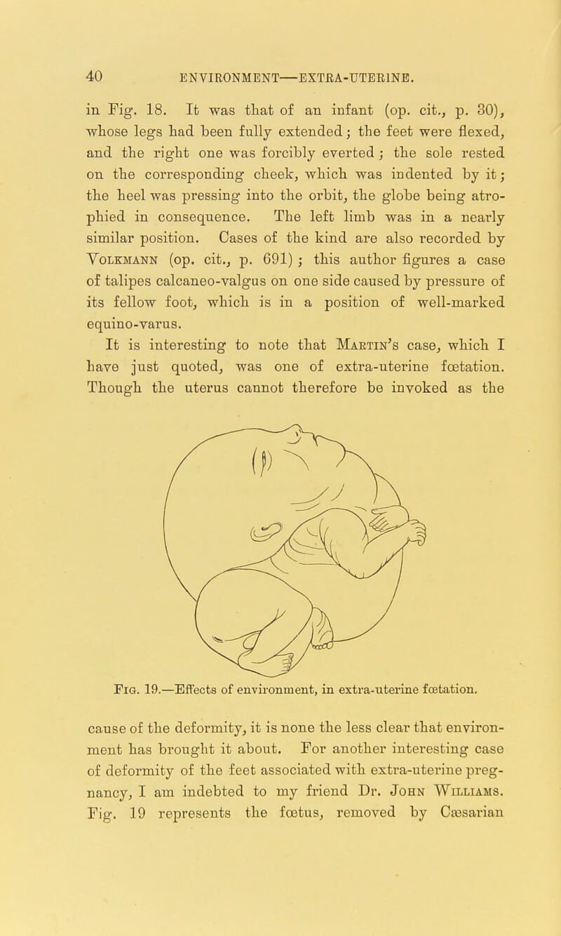 in Fig. 18. It was that of an infant (op. cit., p. 30), whose legs had been fully extended; the feet were flexed, and the right one was forcibly everted ; the sole rested on the corresponding cheek, which was indented by it; the heel was pressing into the orbit, the globe being atro- phied in consequence. The left limb was in a neai'ly similar position. Cases of the kind are also recorded by VoLKMANN (op. cit., p. 691) j this author figures a case of talipes calcaneo-valgus on one side caused by pressure of its fellow foot, which is in a position of well-marked equino-varus. It is interesting to note that Martin's case, which I have just quoted, was one of extra-uterine foetation. Though the uterus cannot therefore be invoked as the FiGr. 19.—Effects of environment, in extra-uterine foetation. cause of the deformity, it is none the less clear that environ- ment has brought it about. For another interesting case of deformity of the feet associated with extra-uterine preg- nancy, I am indebted to my friend Dr. John Williams. Fig. 19 represents the foetus, removed by Caesarian