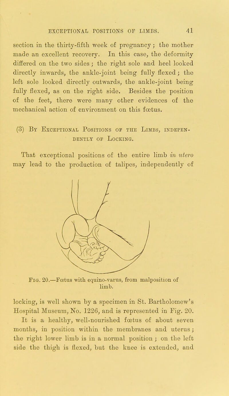 section in the thirty-fifth week of pregnancy; the mother made an excellent recovery. In this case^ the deformity differed, on the two sides; the right sole and heel looked directly inwardsj the ankle-joint being fully flexed; the left sole looked, directly outwards^ the ankle-joint being fully flexed, as on the right side. Besides the position of the feetj there were many other evidences of the mechanical action of environment on this foetus. (3) By Exceptional Positions of the Limbs, indepen- dently OP LOCKINQ. That exceptional positions of the entire limb in utero may lead to the production of talipes, independently of Fig. 20.—Foetus with equino-varus, from malposition of limb. locking, is well shown by a specimen in St. Bartholomew's Hospital Museum, No. 1226, and is represented in Fig. 20. It is a healthy, well-nourished foetus of about seven months, in position within the membranes and. uterus; the right lower limb is in a normal position ; on the left side the thigh is flexed, but the knee is extended, and