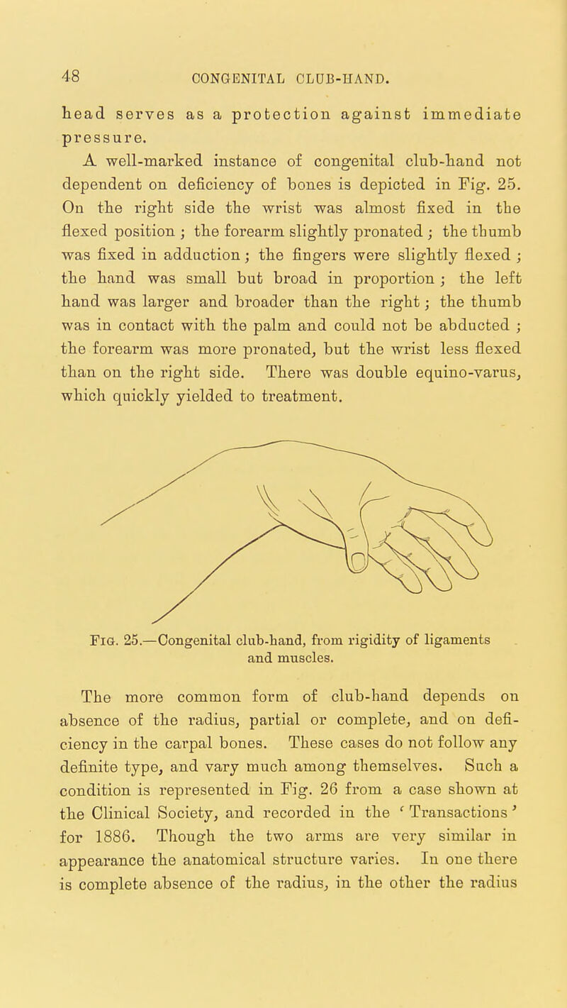 head serves as a protection against immediate pressure. A well-marked instance of congenital club-hand not dependent on deficiency of bones is depicted in Fig. 25. On the right side the wrist was almost fixed in the flexed position ; the forearm slightly pronated ; the tliumb was fixed in adduction; the fingers were slightly flexed ; the hand was small but broad in proportion j the left hand was larger and broader than the right; the thumb was in contact with the palm and could not be abducted ; the forearm was more pronated^ but the wrist less flexed than on the right side. There was double equino-varus, which quickly yielded to treatment. Fia. 25.—Congenital club-hand, from rigidity of ligaments and muscles. The more common form of club-hand depends on absence of the radius, partial or complete, and on defi- ciency in the carpal bones. These cases do not follow any definite type, and vary much among themselves. Such a condition is represented in Pig. 26 from a case shown at the Clinical Society, and recorded in the ' Transactions' for 1886. Though the two arms are very similar in appearance the anatomical structure varies. In one there is complete absence of the radius, in the other the radius