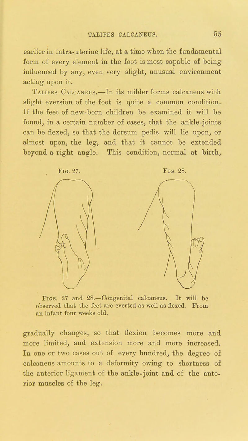 earlier in intra-uterine life^ at a time wlien the fundamental form of every element in tlie foot is most capable of being influenced by any, even very sligbt, unusual environment acting upon it. Talipes Calcaneus.—In its milder forms calcaneus with slight eversion of the foot is quite a common condition. If the feet of new-born children be examined it will be found, in a certain number of cases, that the ankle-joints can be flexed, so that the dorsum pedis will lie upon, or almost upon, the leg, and that it cannot be extended beyond a right angle. This condition, normal at birth. Fig. 27. Fig. 28. Figs. 27 and 28.—Congenital calcaneus. It -will be obseiTed that the feet are everted as well as flexed. From an infant four weeks old. gradually changes, so that flexion becomes more and more limited, and extension more and more increased. In one or two cases out of every hundred, the degree of calcaneus amounts to a deformity owing to shortness of the anterior ligament of the ankle-joint and of the ante- rior muscles of the leg.