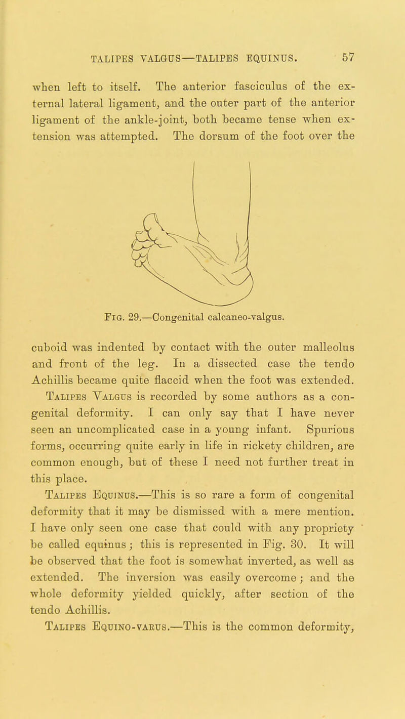 when left to itself. The anterior fasciculus of the ex- ternal lateral ligament^ and the outer part of the anterior ligament of the ankle-joint, both, became tense when ex- tension was attempted. The dorsum of the foot over the Fig. 29,—Congenital calcaneo-valgus. cuboid was indented by contact with. th.e outer malleolus and front of the leg. In a dissected case the tendo Achillis became quite flaccid when the foot was extended. Talipes Yalgus is recorded by some authors as a con- genital deformity. I can only say that I have never seen an uncomplicated case in a young infant. Spurious forms, occurring quite early in life in rickety cMldren, are common enough, but of these I need not further treat in this place. Talipes Equinus.—This is so rare a form of congenital deformity that it may be dismissed with a mere mention. I have only seen one case that could with any propriety be called equinus; this is represented in Fig. 30. It will be observed that the foot is somewhat inverted, as well as extended. The inversion was easily overcome; and the whole deformity yielded quickly, after section of the tendo Achillis. Talipes Equino-vaeus.—This is the common deformity,