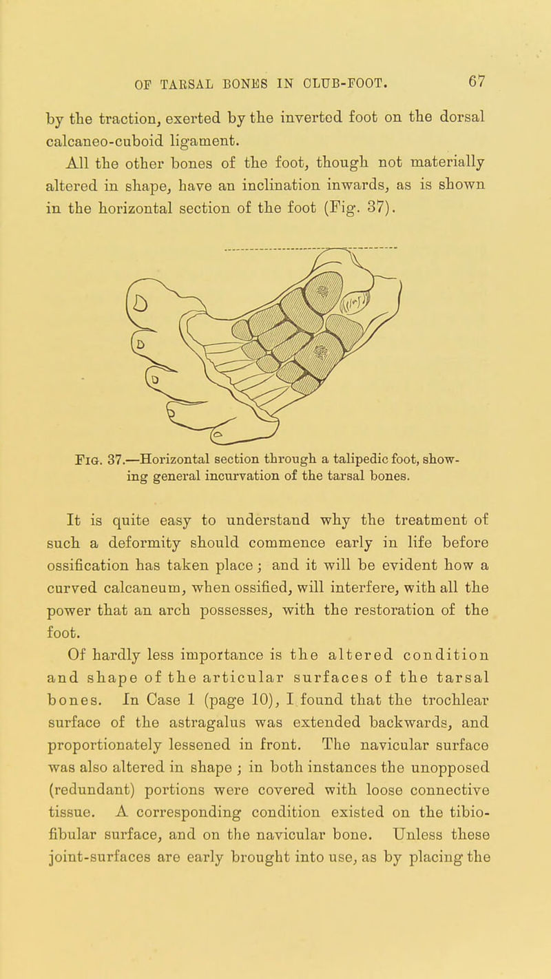 by the traction, exerted by the inverted foot on the dorsal calcaneo-cuboid ligament. All the other bones of the foot, though not materially altered in shape, have an inclination inwards, as is shown in the horizontal section of the foot (Fig. 37). Fig. 37.—Horizontal section through a talipedic foot, show- ing general incurvation of the tarsal bones. It is quite easy to understand why the treatment of such a deformity should commence early in life before ossification has taken place; and it will be evident how a curved calcaneum, when ossified, will interfere, with all the power that an arch possesses, with the restoration of the foot. Of hardly less importance is the altered condition and shape of the articular surfaces of the tarsal bones. In Case 1 (page 10), I found that the trochlear surface of the astragalus was extended backwards, and proportionately lessened in front. The navicular surface was also altered in shape ; in both instances the unopposed (redundant) portions were covered with loose connective tissue. A corresponding condition existed on the tibio- fibular surface, and on the navicular bone. Unless these joint-surfaces are early brought into use, as by placing the