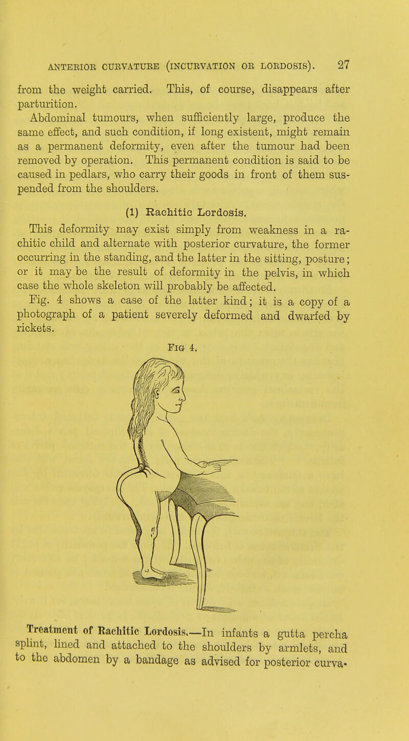 from the weight carried. This, of course, disappears after parturition. Abdominal tumours, when sufficiently large, produce the same effect, and such condition, if long existent, might remain as a permanent deformity, even after the tumour had been removed by operation. This permanent condition is said to be caused in pedlars, who carry their goods in front of them sus- pended from the shoulders. This deformity may exist simply from weakness in a ra- chitic child and alternate with posterior curvature, the former occurring in the standing, and the latter in the sitting, posture; or it may be the result of deformity in the pelvis, in which case the whole skeleton will probably be affected. Fig. 4 shows a case of the latter kind; it is a copy of a photograph of a patient severely deformed and dwarfed by rickets. Treatment of Kachitic Lordosis—In infants a gutta percha splint, lined and attached to the shoulders by armlets, and to the abdomen by a bandage as advised for posterior curva- (1) Rachitic Lordosis. Fig 4.