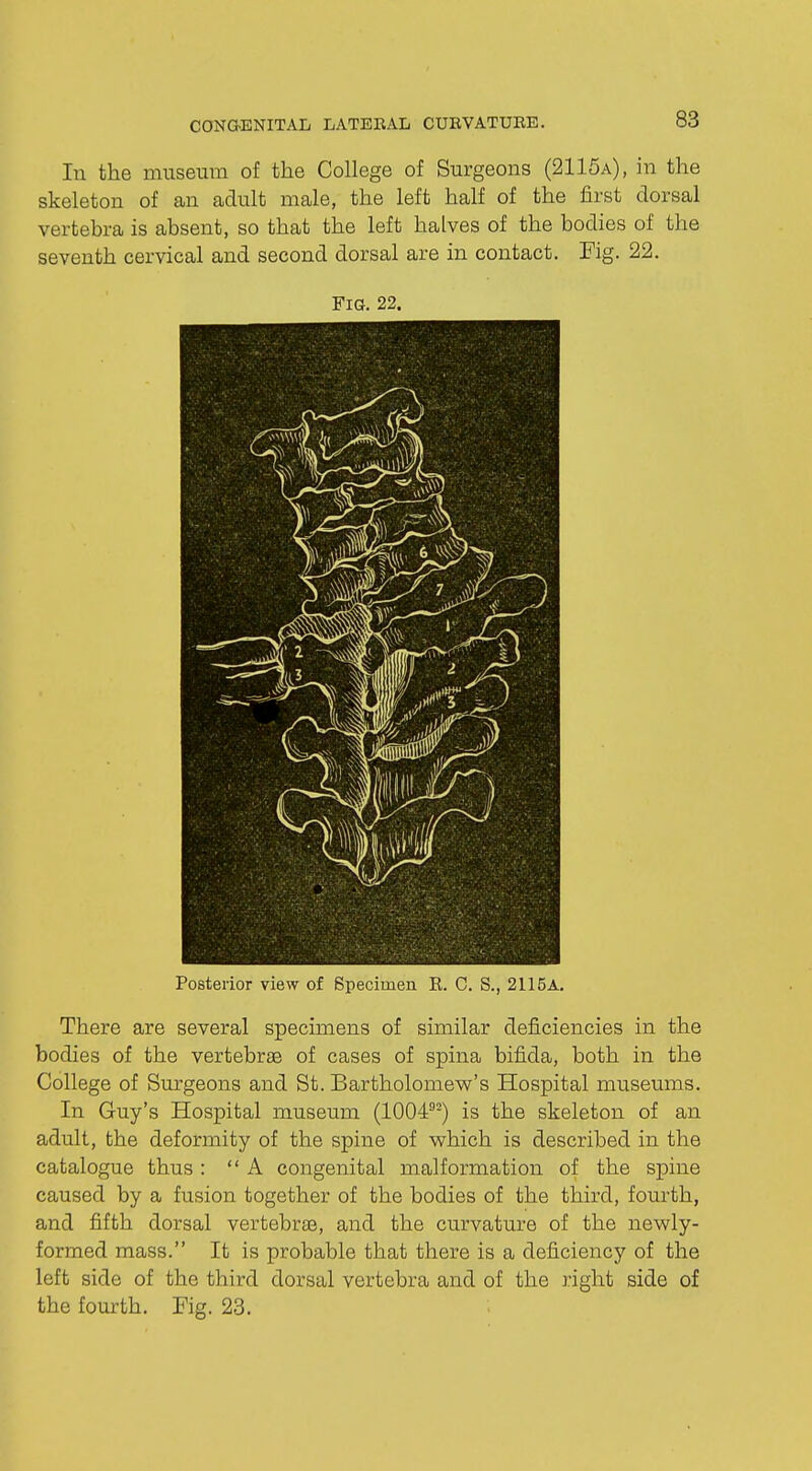 In the museum of the College of Surgeons (2115a), in the skeleton of an adult male, the left half of the first dorsal vertebra is absent, so that the left halves of the bodies of the seventh cervical and second dorsal are in contact. Fig. 22. Fig. 22. Posterior view of Specimen R. C. S., 2115A. There are several specimens of similar deficiencies in the bodies of the vertebra of cases of spina bifida, both in the College of Surgeons and St. Bartholomew's Hospital museums. In Guy's Hospital museum (100492) is the skeleton of an adult, the deformity of the spine of which is described in the catalogue thus : A congenital malformation of the spine caused by a fusion together of the bodies of the third, fourth, and fifth dorsal vertebrae, and the curvature of the newly- formed mass. It is probable that there is a deficiency of the left side of the third dorsal vertebra and of the right side of the fourth. Fig. 23.