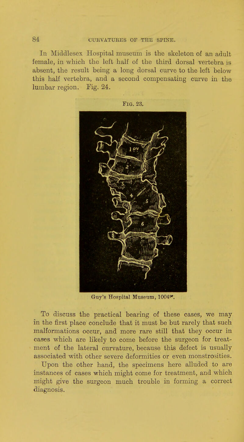 In Middlesex Hospital museum is the skeleton of an adult female, in which the left half of the third dorsal vertebra is absent, the result being a long dorsal curve to the left below this half vertebra, and a second compensating curve in the lumbar region. Fig. 24. Fig. 23. Guy's Hospital Museum, 10045*. To discuss the practical bearing of these cases, we may in the first place conclude that it must be but rarely that such malformations occur, and more rare still that they occur in cases which are likely to come before the surgeon for treat- ment of the lateral curvature, because this defect is usually associated with other severe deformities or even monstrosities. Upon the other hand, the specimens here alluded to are instances of cases which might come for treatment, and which might give the surgeon much trouble in forming a correct diagnosis.