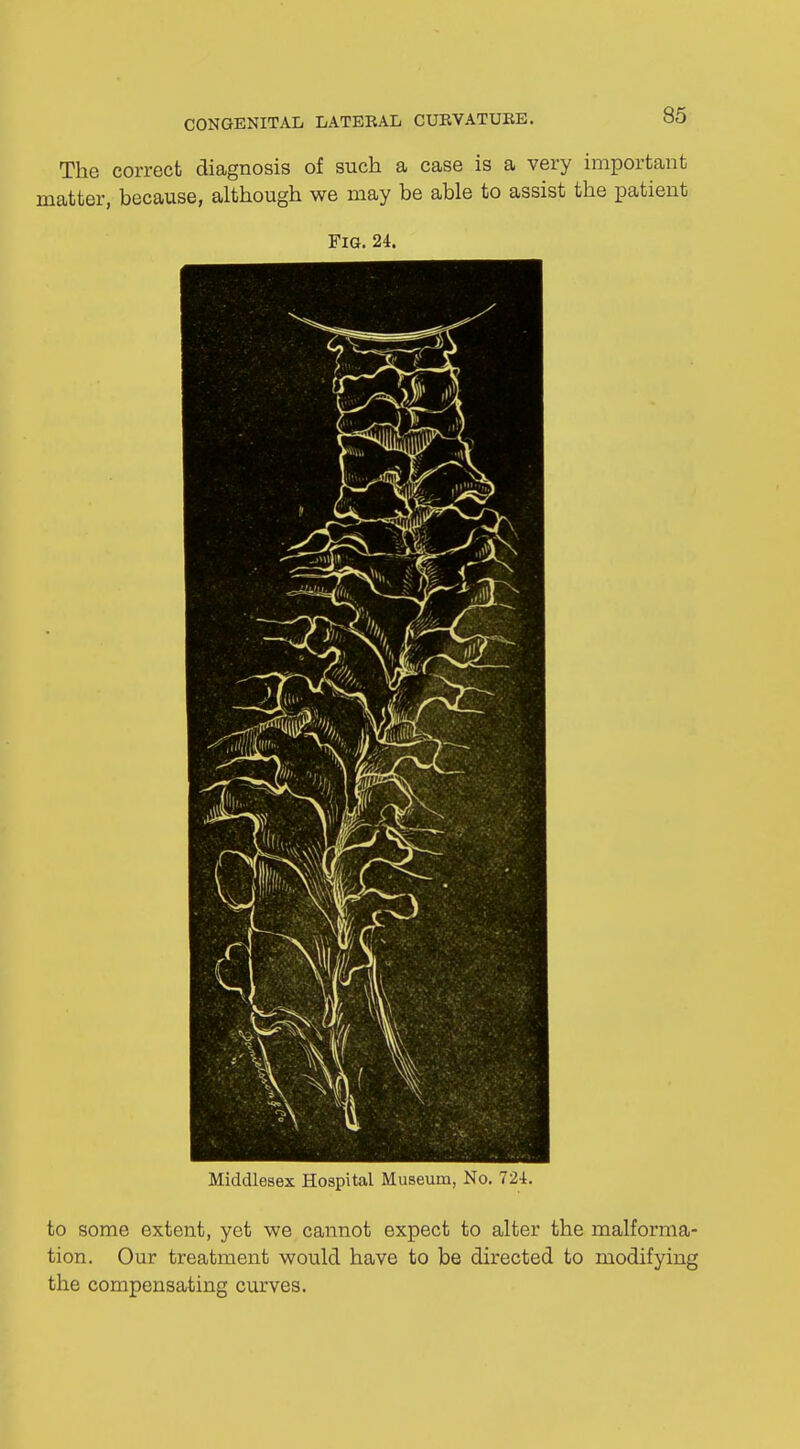 The correct diagnosis of such a case is a very important matter, because, although we may be able to assist the patient Fig. 24. Middlesex Hospital Museum, No. 724. to some extent, yet we cannot expect to alter the malforma- tion. Our treatment would have to be directed to modifying the compensating curves.