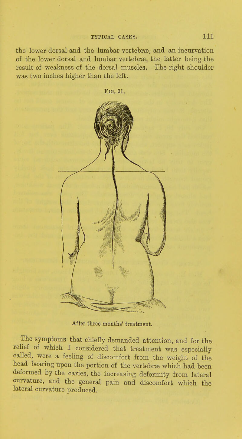 the lower dorsal and the lumbar vertebrae, and an incurvation of the lower dorsal and lumbar vertebrae, the latter being the result of weakness of the dorsal muscles. The right shoulder was two inches higher than the left. Fig. 31. After three months' treatment. The symptoms that chiefly demanded attention, and for the relief of which I considered that treatment was especially called, were a feeling of discomfort from the weight of the head bearing upon the portion of the vertebra which had been deformed by the caries, the increasing deformity from lateral curvature, and the general pain and discomfort which the lateral curvature produced.