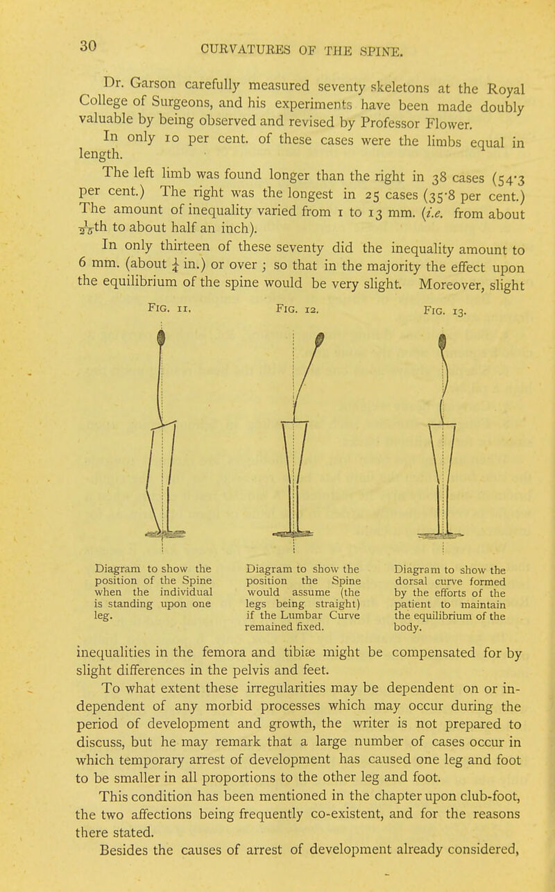 Dr. Garson carefully measured seventy skeletons at the Royal College of Surgeons, and his experiments have been made doubly valuable by being observed and revised by Professor Flower. In only lo per cent, of these cases were the limbs equal in length. The left limb was found longer than the right in 38 cases (54-3 per cent.) The right was the longest in 25 cases (35-8 per cent.) The amount of inequality varied from i to 13 mm. {i.e. from about ^th to about half an inch). In only thirteen of these seventy did the inequality amount to 6 mm. (about \ in.) or over ; so that in the majority the effect upon the equilibrium of the spine would be very slight. Moreover, slight Fig. II, Fig. 12. Fig. 13. Diagram to show the position of the Spine when the individual is standing upon one leg. Diagram to show the position the Spine would assume (the legs being straight) if the Lumbar Curve remained fixed. Diagram to show the dorsal curve formed by the efforts of the patient to maintain the equilibrium of the body. inequalities in the femora and tibite might be compensated for by slight differences in the pelvis and feet. To what extent these irregularities may be dependent on or in- dependent of any morbid processes which may occur during the period of development and growth, the writer is not prepared to discuss, but he may remark that a large number of cases occur in which temporary arrest of development has caused one leg and foot to be smaller in all proportions to the other leg and foot. This condition has been mentioned in the chapter upon club-foot, the two affections being frequently co-existent, and for the reasons there stated. Besides the causes of arrest of development already considered,