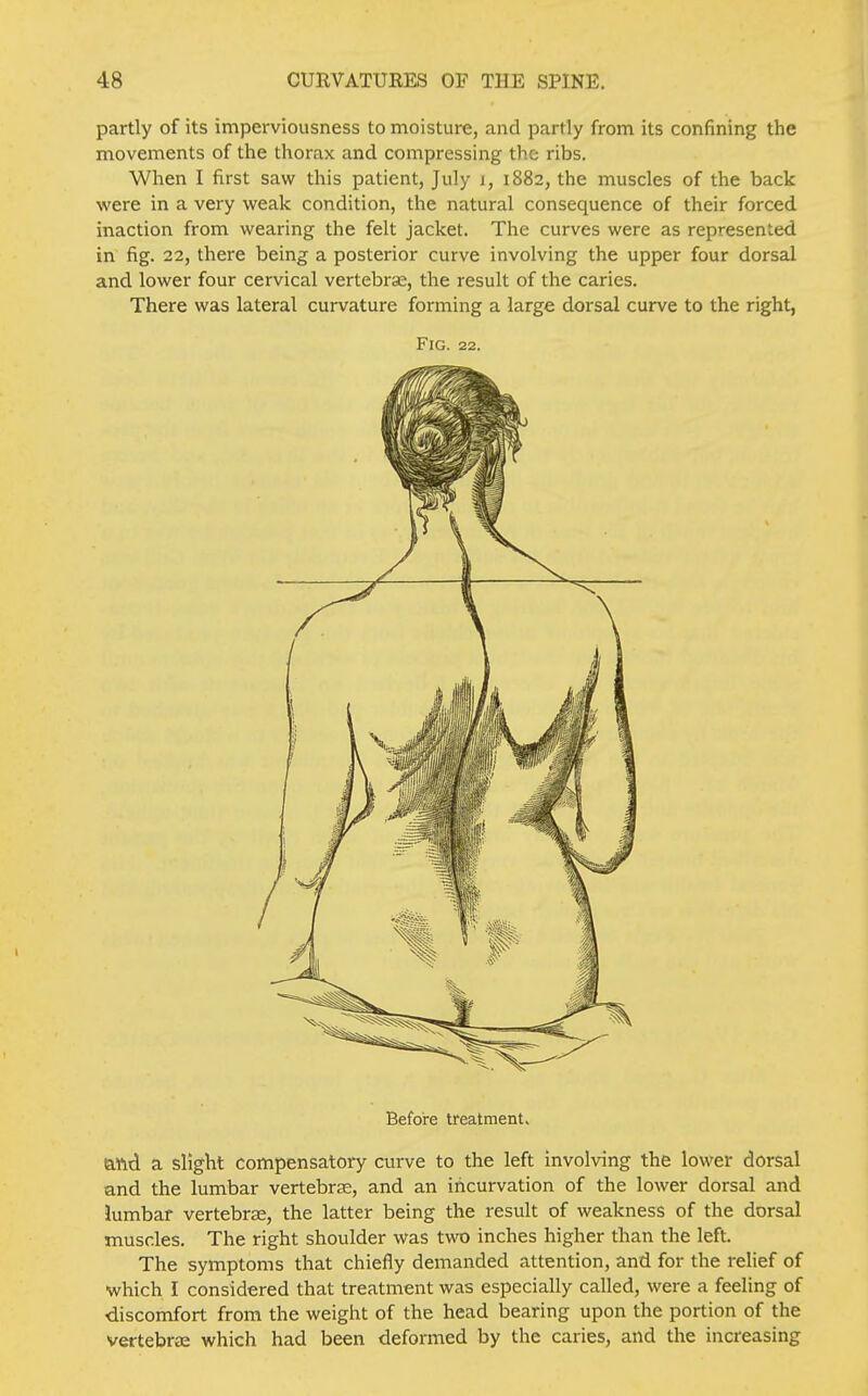 partly of its imperviousness to moisture, and partly from its confining the movements of the thorax and compressing the ribs. When I first saw this patient, July i, 1882, the muscles of the back were in a very weak condition, the natural consequence of their forced inaction from wearing the felt jacket. The curves were as represented in fig. 22, there being a posterior curve involving the upper four dorsal and lower four cervical vertebrae, the result of the caries. There was lateral curvature forming a large dorsal curve to the right, Fig. 22. Before treatment. aftd a slight compensatory curve to the left involving the lower dorsal and the lumbar vertebras, and an incurvation of the lower dorsal and lumbar vertebra;, the latter being the result of weakness of the dorsal muscles. The right shoulder was two inches higher than the left. The symptoms that chiefly demanded attention, and for the relief of •which I considered that treatment was especially called, were a feeling of discomfort from the weight of the head bearing upon the portion of the vertebras which had been deformed by the caries, and the increasing