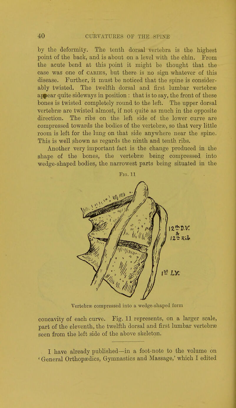 by the deformity. The tenth dorsal vertebra is the highest point of the back, and is about on a level with the chin. From the acute bend at this point it might be thought that the case was one of caeies, but there is no sign whatever of this disease. Further, it must be noticed that the spine is consider- ably twisted. The twelfth dorsal and first lumbar vertebrae ap|)ear quite sideways in position : that is to say, the front of these bones is twisted completely round to the left. The upper dorsal vertebrae are twisted almost, if not quite as much in the opposite direction. The ribs on the left side of the lower curve are compressed towards the bodies of the vertebrfe, so that very little room is left for the lung on that side anywhere near the spine. This is well shown as regards the ninth and tenth ribs. Another very important fact is the change produced in the shape of the bones, the vertebra being compressed into wedge-shaped bodies, the narrowest parts being situated in the Fig. 11 Vertebras compressed into a wedge-shaped form concavity of each curve. Fig. 11 represents, on a larger scale, part of the eleventh, the twelfth dorsal and first lumbar vertebree seen from the left side of the above skeleton. I have already published—in a foot-note to the volume on ' General Orthopaedics, Gymnastics and Massage,' which I edited
