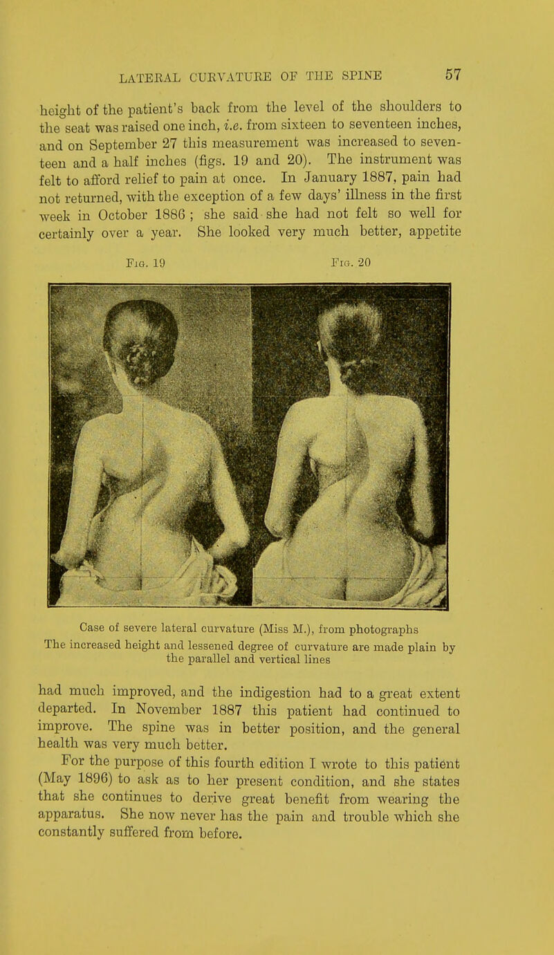 height of the patient's back from the level of the shoulders to the seat was raised one inch, i.e. from sixteen to seventeen inches, and on September 27 this measurement was increased to seven- teen and a half inches (figs. 19 and 20). The instrument was felt to afford rehef to pain at once. In January 1887, pain had not returned, with the exception of a few days' iUness in the first week in October 1886; she said she had not felt so well for certainly over a year. She looked very much better, appetite Fig. 19 Fra. 20 Case of severe lateral curvature (Miss M.), from photographs The increased height and lessened degree of curvature are made plain by the parallel and vertical lines had much improved, and the indigestion had to a great extent departed. In November 1887 this patient had continued to improve. The spine was in better position, and the general health was very much better. For the purpose of this fourth edition I wrote to this patient (May 1896) to ask as to her present condition, and she states that she continues to derive great benefit from wearing the apparatus. She now never has the pain and trouble which she constantly suffered from before.