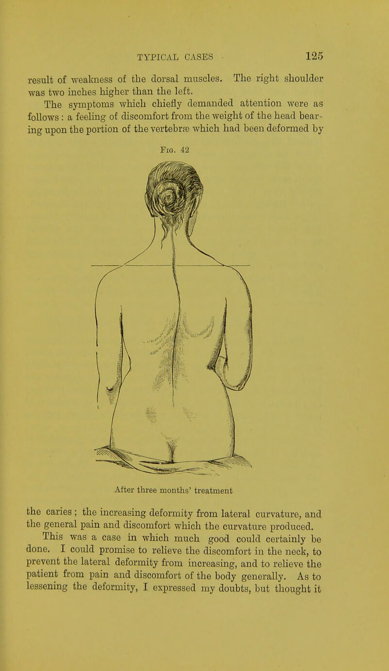 result of weakness of the dorsal muscles. The right shoulder was two inches higher than the left. The symptoms which chiefly demanded attention were as follows : a feeling of discomfort from the weight of the head bear- ing upon the portion of the vertebrfe which had been deformed by Fig. 42 After three months' treatment the caries ; the increasing deformity from lateral curvature, and the general pain and discomfort which the curvature produced. This was a case in which much good could certainly be done. I could promise to reheve the discomfort in the neck, to prevent the lateral deformity from increasing, and to reheve the patient from pain and discomfort of the body generally. As to lessening the deformity, I expressed my doubts, but thought it