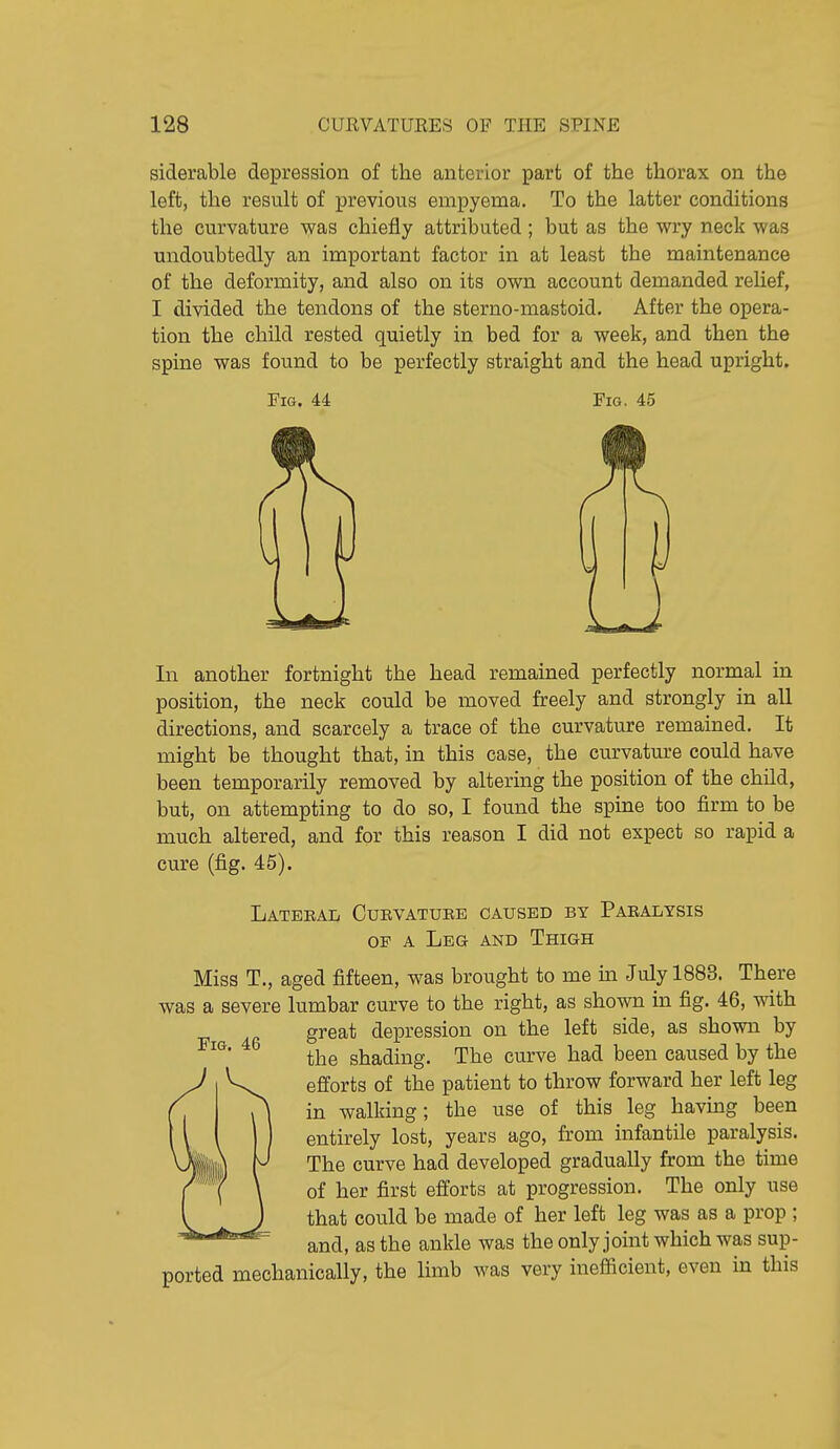 siderable depression of the anterior part of the thorax on the left, the result of previous empyema. To the latter conditions the curvature vyas chiefly attributed; but as the wry neck was undoubtedly an important factor in at least the maintenance of the deformity, and also on its own account demanded rehef, I divided the tendons of the sterno-mastoid. After the opera- tion the child rested quietly in bed for a week, and then the spine was found to be perfectly straight and the head upright. Fig. 44 Fig. 45 In another fortnight the head remained perfectly normal in position, the neck could be moved freely and strongly in all directions, and scarcely a trace of the curvature remained. It might be thought that, in this case, the curvatm-e could have been temporarily removed by altering the position of the child, but, on attempting to do so, I found the spine too firm to be much altered, and for this reason I did not expect so rapid a cure (fig. 45). Latebal Cuevatube caused by Paealysis OF A Leg and Thigh Miss T., aged fifteen, was brought to me m July 1883. There was a severe lumbar curve to the right, as shown in fig. 46, with great depression on the left side, as shown by the shading. The curve had been caused by the efforts of the patient to throw forward her left leg in walking; the use of this leg havmg been entirely lost, years ago, from infantile paralysis. The curve had developed gradually from the time of her first efforts at progression. The only use that could be made of her left leg was as a prop ; and, as the ankle was theonlyjoint which was sup- ported mechanically, the limb was very inefficient, even in this