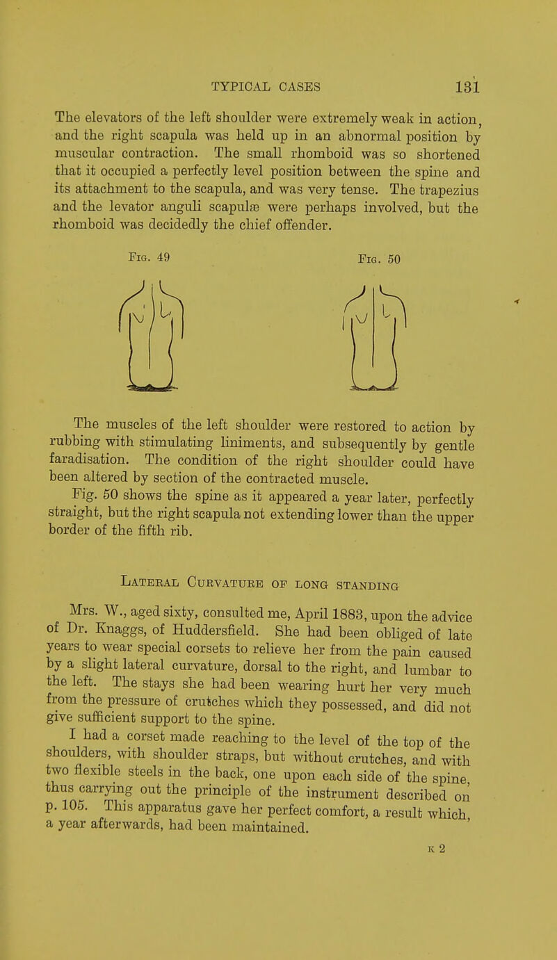 The elevators of the left shoulder were extremely weak in action, and the right scapula was held up in an abnormal position by muscular contraction. The small rhomboid was so shortened that it occupied a perfectly level position between the spine and its attachment to the scapula, and was very tense. The trapezius and the levator anguli scapulte were perhaps involved, but the rhomboid was decidedly the chief offender. Fig. 49 Fig. 50 The muscles of the left shoulder were restored to action by rubbing with stimulating liniments, and subsequently by gentle faradisation. The condition of the right shoulder could have been altered by section of the contracted muscle. Fig. 50 shows the spine as it appeared a year later, perfectly straight, but the right scapula not extending lower than the upper border of the fifth rib. Lateeal Curvatube of long standing Mrs. W., aged sixty, consulted me, AprU 1883, upon the advice of Dr. Knaggs, of Huddersfield. She had been obliged of late years to wear special corsets to relieve her from the pain caused by a slight lateral curvature, dorsal to the right, and lumbar to the left. The stays she had been wearing hurt her very much from the pressure of crutches which they possessed, and did not give sufficient support to the spine. I had a corset made reaching to the level of the top of the shoulders, with shoulder straps, but without crutches, and with two flexible steels in the back, one upon each side of the spine thus carrymg out the principle of the instrument described on p. 105. This apparatus gave her perfect comfort, a result which a year afterwards, had been maintained. IC 2