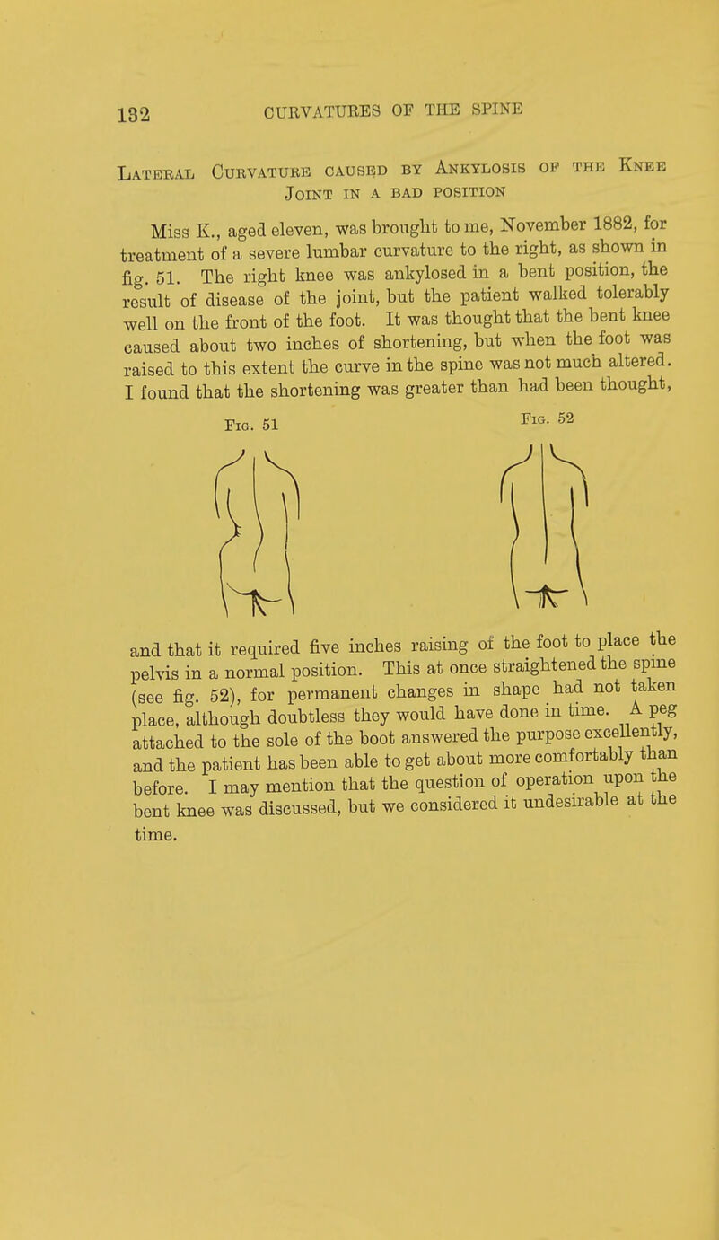 Lateeal Curvatukb caused by Ankylosis op the Knee Joint in a bad position Miss K., aged eleven, was brought tome, November 1882, for treatment of a severe lumbar curvature to tbe rigbt, as shown in fig. 51. The right knee was ankylosed in a bent position, the result of disease of the joint, but the patient walked tolerably well on the front of the foot. It was thought that the bent knee caused about two inches of shortening, but when the foot was raised to this extent the curve in the spine was not much altered. I found that the shortening was greater than had been thought, Fig. 51 Fig. 52 and that it required five inches raising of the foot to place the pelvis in a normal position. This at once straightened the spme (see fig. 52), for permanent changes in shape had not taken place, although doubtless they would have done in time. A peg attached to the sole of the boot answered the purpose excellently, and the patient has been able to get about more comfortably than before. I may mention that the question of operation upon the bent knee was discussed, but we considered it undesirable at the time.