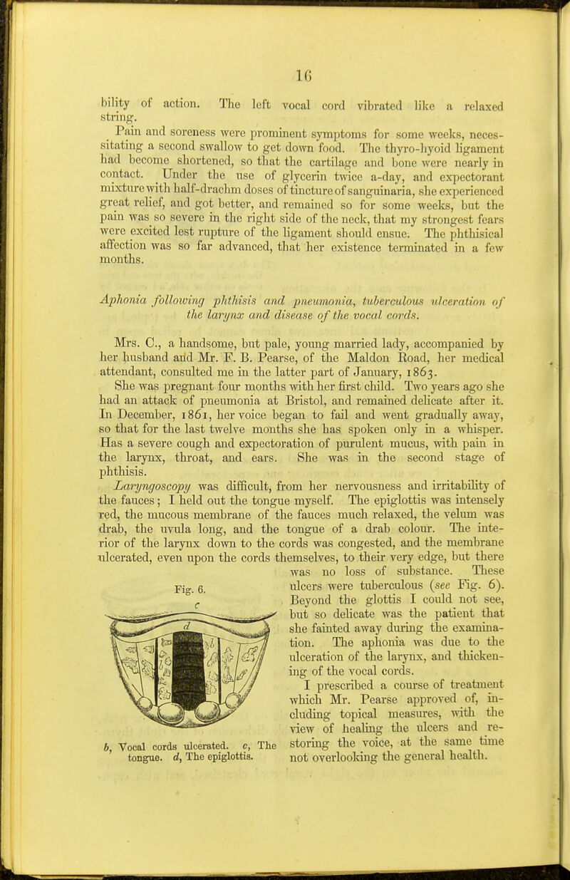 IG bility of action. The left vocal cord vibrated like a relaxed string. Pain and soreness were prominent symptoms for some weeks, neces- sitating a second swallow to get do^vn food. Tiie thyro-liyoid ligament had become shortened, so that the cartilage and bone were nearly in contact. ^ Under the use of glycerin twice a-day, and expectorant mixture with half-drachm doses of tincture of sanguinaria, she experienced great relief, and got better, and remained so for some weeks, but the pain was_ so severe in the right side of the neck, that my strongest fears were excited lest rupture of the ligament should ensue. The phthisical affection was so far advanced, that her existence terminated in a few mouths. Aphonia following phthisis and pneumonia, tuberculous ulceration of the larynx and disease of the vocal cords. Mrs. C, a handsome, but pale, young married lady, accompanied by her husband arid Mr. F. B. Pearse, of the Maldon Eoad, her medical attendant, consulted me in the latter part of January, 1863. She was pregnant fom* months with her first child. Two years ago she had an attack of pneumonia at Bristol, and remained delicate after it. In December, 1861, her voice began to fail and went gradually away, so that for the last twelve months she has spoken only in a whisper. Has a severe cough and expectoration of purulent mucus, with pain in the larynx, thi'oat, and ears. She was in the second stage of phthisis. Laryngoscopy was difficult, from her nervousness and irritability of the fauces; I held out the tongue myself. The epiglottis was intensely red, the mucous membrane of the fauces much relaxed, the velum was drab, the uvula long, and the tongue of a di-ab colour. The inte- rior of the larynx down to the cords was congested, and the membrane idcerated, even upon the cords themselves, to their very edge, but there was no loss of substance. Tliese ulcers were tuberculous (see Fig. 6). Beyond the glottis I could not see, biit so delicate was the patient that she fainted away dming the examina- tion. The aphonia was due to the ulceration of the larynx, and thicken- ing of the vocal cords. I prescribed a course of treatment which Mr. Pearse approved of, in- cluding topical measures, with the view of healing the ulcers and re- Vocal cords ulcerated, c. The storing the voice, at the same time tongue, rf, The epiglottis. not overlooking the general health.