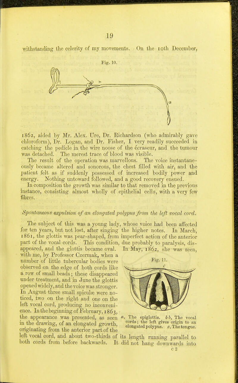 >yithstanding tlie celerity of my movements. On tlie loth December, Fig. 10. 1862, aided by Mr. Alex. Ure, Dr. Richardson (who admirably gave chlorofonn). Dr. Logan, and Dr. Fisher, I very readily succeeded in catching the pedicle in the wire noose of the ecraseur, and the tumour was detached. The merest trace of blood was visible. The result of the operation was marvellous. Tlie voice instantane- ously became altered and sonorous, the chest filled with air, and the patient felt as if suddenly possessed of increased bodily power and energy. Nothing untoward followed, and a good recovery ensued. In composition the growth was similar to that removed in the previous instance, consisting almost wholly of epithelial cells, with a very few fibres. Spontaneous expulsion of an elongated polypus from, the left vocal cord. The subject of this was a young lady for ten years, but not lost, after singing 1861, the glottis was pear-shaped, from part of the vocal cords. This condition, appeared, and the glottis became oval, with me, by Professor Czermak, when a number of little tubercular bodies were observed on the edge of both cords Klce a row of small beads ; these disappeared under treatment, and in June the glottis opened widely, and the voice was stronger. In August thi-ee small spicula; were no- ticed, two on the right and one on the left vocal cord, producing no inconveni- ence. In the beginning of February, 1863, the appearance was presented, as seen in the drawing, of an elongated growth, originating from the anterior part of the left vocal cord, and about two-tliirds of both cords from before baclcwards. It , whose voice had been afiected the higher notes. In March, imperfect action of the anterior due probably to paralysis, dis- In May, 1862, she was seen, a, The epiglottis, bb, The vocal cords; the left gives orig^in to an elongated polypus, c, The tongue. its length running parallel to did not hang downwards into c 2