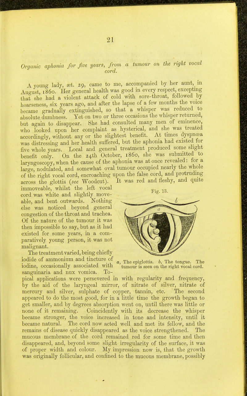 Organic aphonia for five years, from a tumour on the right vocal cord. A young lady, tet. 29, came to me, accompanied by her aunt, in August, 1860. Her general health was good in every respect, excepting that she had a violent attack of cold with sore-throat, followed by hoarseness, six years ago, and after the lapse of a few months the voice became gradually extmguished, so that a whisper was reduced to absolute dumbness. Yet on two or three occasions the whisper returned, but again to disappear. She had consulted many men of eminence, who looked upon her complaint as hysterical, and she was treated accordingly, mthout any or the slightest benefit. At times dyspnoea was distressing and her health suffered, but the aphonia had existed for five whole years. Local and general treatment produced some shght benefit only. On the Z4th October, i860, she was submitted to laryngoscopy, when the cause of the aphonia was at once revealed: for a large, nodulated, and somewhat oval tumour occupied nearly the whole of the right vocal cord, encroaching upon the false cord, and protruding across the glottis {see Woodcut). It was red and fleshy, and qmte immoveable, whilst the left vocal cord was white and slightly move- able, and bent outwards. Nothing else was noticed beyond general congestion of the throat and trachea. Of the nature of the tumour it was then impossible to say, but as it had existed for some years, in a com- paratively young person, it was not malignant. The treatment varied, being chiefly iodide of ammonium and tincture of ^he epiglottis, b, The tongue. The iodine, occasionally associated with tumour is seen on the right vocal cord, sanguinaria and nux vomica. To- pical applications were persevered in with regularity and frequency, by the aid of the laryngeal mirror, of nitrate of silver, nitrate of mercury and silver, sulphate of copper, tannin, etc. The second appeared to do the most good, for in a little time the growth began to get smaller, and by degrees absorption went on, until there was little or none of it remauiing. Coincidently with its decrease the whisper became stronger, the voice increased in tone and intensity, until it became natural. Tlie cord now acted well and met its fellow, and the remains of disease quickly disappeared as the voice strengthened. The mucous membrane of the cord remained red for some time and then disappeared, and, beyond some slight iiTcgularity of the surface, it was of proper width and colour. My impression now is, that the growth was originally follicular, and confined to the mucous membrane, possibly