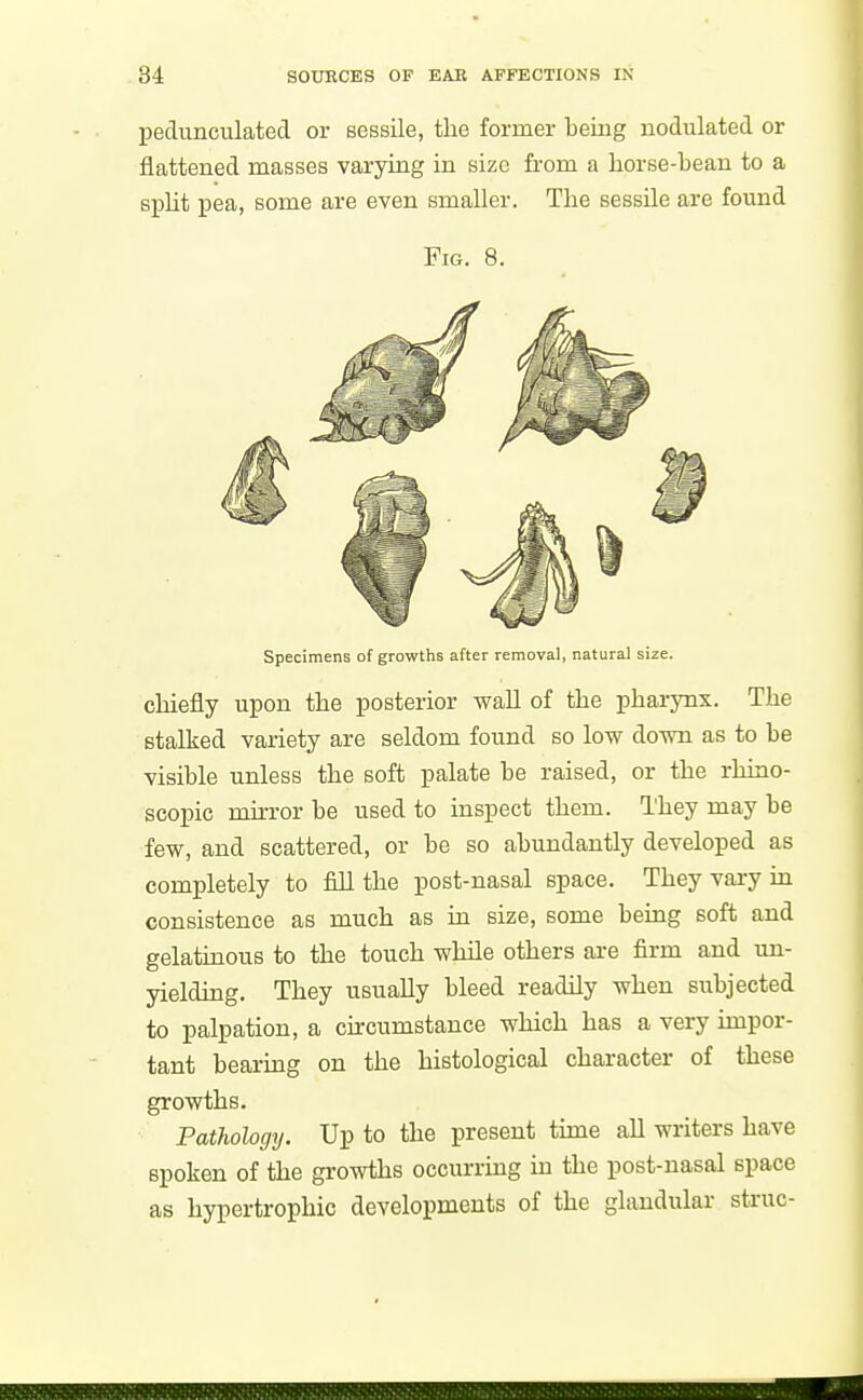 l^edunculated or Bessile, the former being nodulated or flattened masses varying in size from a horse-bean to a spht pea, some are even smaller. The sessile are found Fig. 8. Specimens of growths after removal, natural size. chiefly upon the posterior wall of the pharynx. The stalked variety are seldom found so low down as to be visible unless the soft palate be raised, or the rhiao- scopic mirror be used to inspect them. They may be few, and scattered, or be so abundantly developed as completely to fill the post-nasal space. They vary hi consistence as much as in size, some being soft and gelathious to the touch while others are firm and un- yielding. They usually bleed readily when subjected to palpation, a circumstance which has a very hnpor- tant bearmg on the histological character of these growths. Pathology. Up to the present time all writers have spoken of the growths occurring in the post-nasal space as hypertrophic developments of the glandular struc-