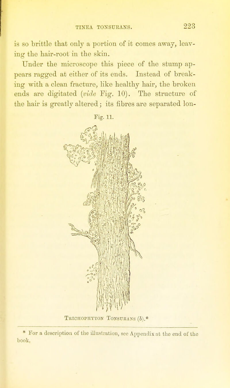is so brittle that only a portion of it comes away, leav- ing the hair-root in the skin. Under the microscope this piece of the stnmp ap- pears ragged at either of its ends. Instead of break- ing with a clean fracture, like healthy hair, the broken ends are digitated (vide Fig. 10). The structure of the hah- is greatly altered; its fibres are separated Ion- Fig, ll. Trichophyton Tonsueans (5).* * For a description of the illustration, see Appendix at the end of the book.