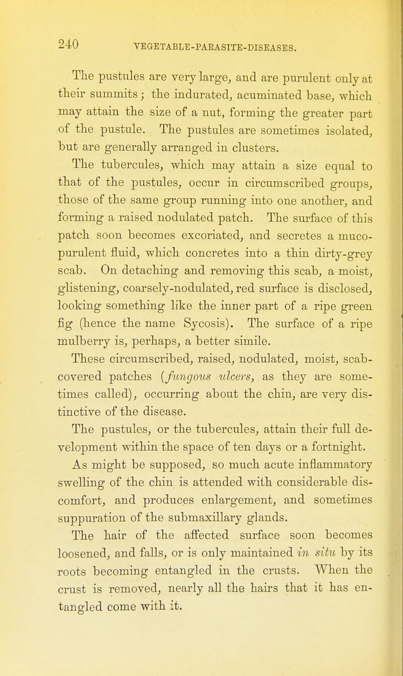 The pustules are very large, and are purulent only at their summits; the indurated, acuminated base, which may attain the size of a nut, forming the greater part of the pustule. The pustules are sometimes isolated, hut are generally arranged in clusters. The tubercules, which may attain a size equal to that of the pustules, occur in circumscribed groups, those of the same group running into one another, and forming a raised nodulated patch. The surface of this patch soon becomes excoriated, and secretes a muco- purulent fluid, which concretes into a thin dirty-grey scab. On detaching and removing this scab, a moist, glistening, coarsely-nodulated, red surface is disclosed, looking something like the inner part of a ripe green fig (hence the name Sycosis). The surface of a ripe mulberry is, perhaps, a better simile. These circumscribed, raised, nodulated, moist, scab- covered patches {fungous ulcers, as they are some- times called), occurring about the chin, are very dis- tinctive of the disease. The pustules, or the tubercules, attain their full de- velopment within the space of ten days or a fortnight. As might be supposed, so much acute inflammatory swelling of the chin is attended with considerable dis- comfort, and produces enlargement, and sometimes suppuration of the submaxillary glands. The hair of the affected surface soon becomes loosened, and falls, or is only maintained in situ by its roots becoming entangled in the crusts. When the crust is removed, nearly all the hairs that it has en- tangled come with it.