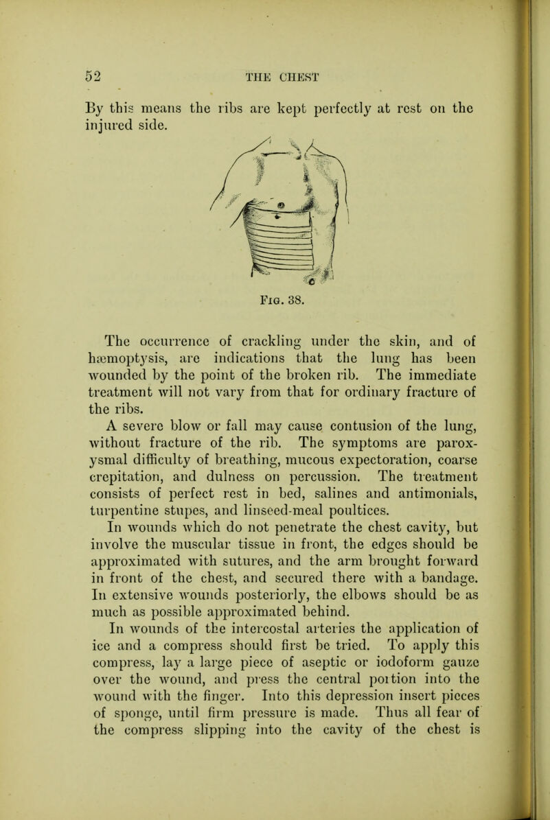 By this means the ribs are kept perfectly at rest on the injured side. The occurrence of crackling under the skin, and of haimoptysis, are indications that the lung has been wounded by the point of the broken rib. The immediate treatment will not vary from that for ordinary fracture of the ribs. A severe blow or fall may cause contusion of the lung, without fracture of the rib. The symptoms are parox- ysmal difficulty of breathing, mucous expectoration, coarse crepitation, and dulness on percussion. The treatment consists of perfect rest in bed, salines and antimonials, turpentine stupes, and linseed-meal poultices. In wounds which do not penetrate the chest cavity, but involve the muscular tissue in front, the edges should be approximated with sutures, and the arm brought forward in front of the chest, and secured there with a bandage. In extensive wounds posteriorly, the elbows should be as much as possible approximated behind. In wounds of the intercostal arteries the application of ice and a compress should first be tried. To apply this compress, lay a large piece of aseptic or iodoform gauze over the wound, and press the central poition into the wound with the finger. Into this depression insert pieces of sponge, until firm pressure is made. Thus all fear of the compress slipping into the cavity of the chest is Fig. 38.