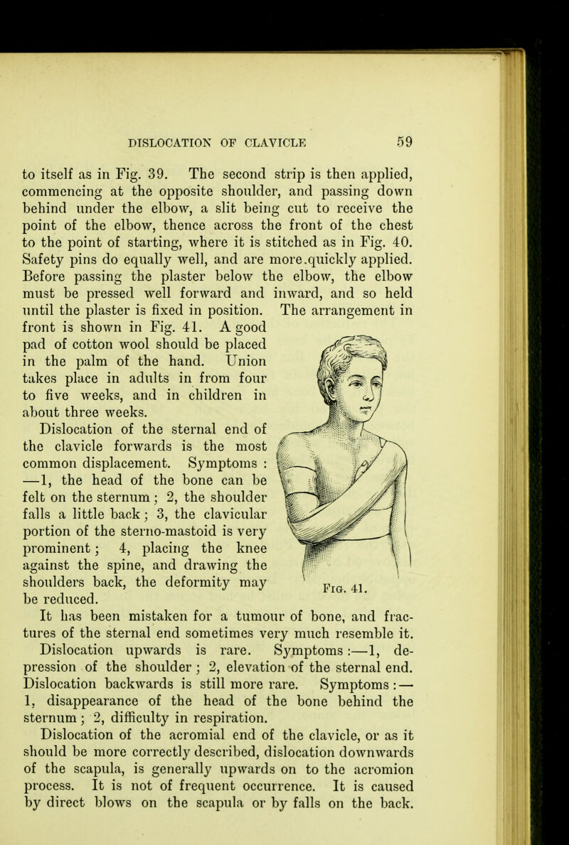 to itself as in Fig. 39. The second strip is then applied, commencing at the opposite shoulder, and passing down behind under the elbow, a slit being cut to receive the point of the elbow, thence across the front of the chest to the point of starting, where it is stitched as in Fig. 40. Safety pins do equally well, and are more.quickly applied. Before passing the plaster below the elbow, the elbow must be pressed well forward and inward, and so held until the plaster is fixed in position. The arrangement in front is shown in Fig. 41. A good pad of cotton wool should be placed in the palm of the hand. Union takes place in adults in from four to five weeks, and in children in about three weeks. Dislocation of the sternal end of the clavicle forwards is the most common displacement. Symptoms : —1, the head of the bone can be felt on the sternum ; 2, the shoulder falls a little back; 3, the clavicular portion of the sterno-mastoid is very prominent; 4, placing the knee against the spine, and drawing the shoulders back, the deformity may be reduced. It has been mistaken for a tumour of bone, and frac- tures of the sternal end sometimes very much resemble it. Dislocation upwards is rare. Symptoms :—1, de- pression of the shoulder ; 2, elevation of the sternal end. Dislocation backwards is still more rare. Symptoms : — 1, disappearance of the head of the bone behind the sternum; 2, difficulty in respiration. Dislocation of the acromial end of the clavicle, or as it should be more correctly described, dislocation downwards of the scapula, is generally upwards on to the acromion process. It is not of frequent occurrence. It is caused by direct blows on the scapula or by falls on the back.