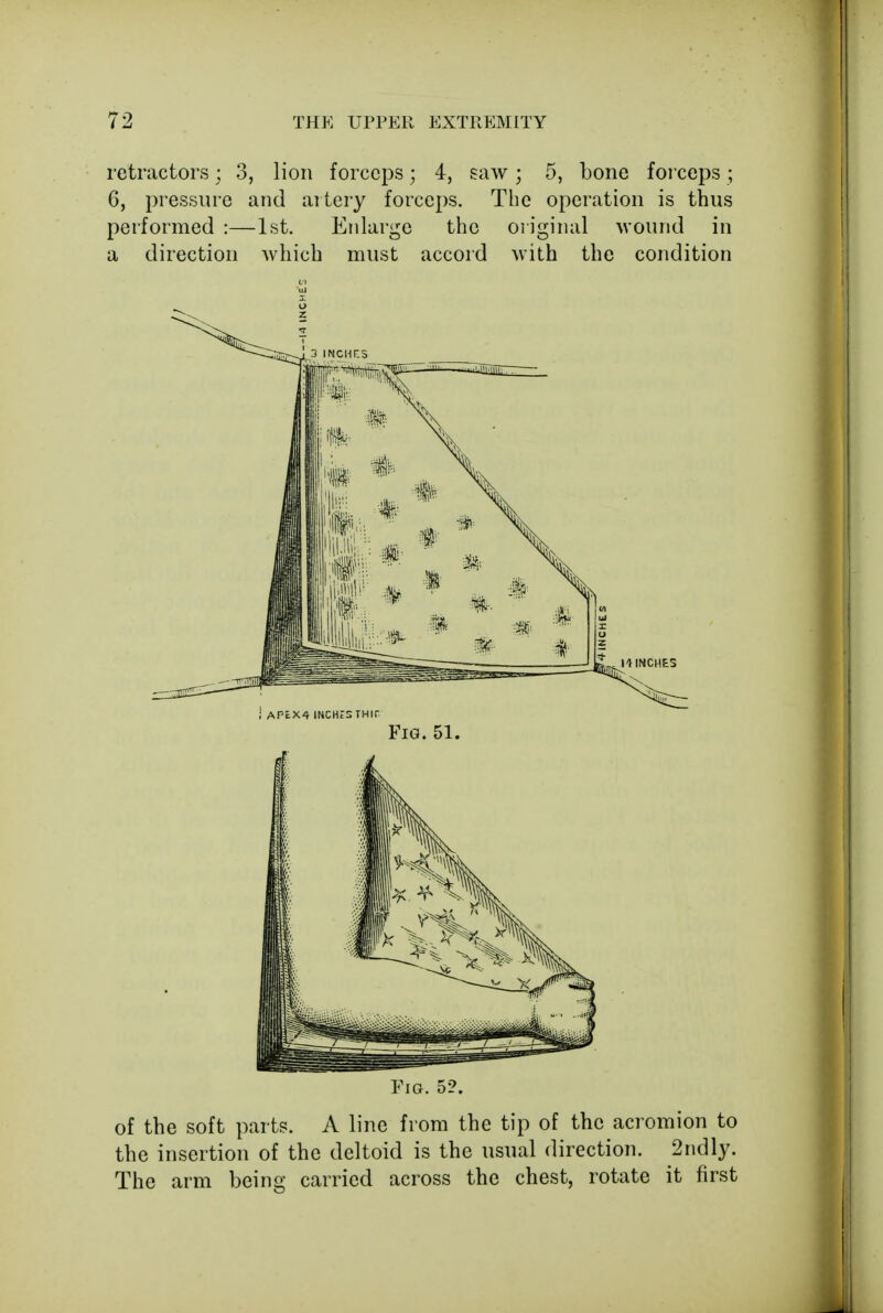 retractors; 3, lion forceps; 4, saw; 5, bone forceps ; 6, pressure and artery forceps. The operation is thus performed :—1st. Enlarge the original wound in a direction which must accord with the condition Fig. 51. Fig. 5?. of the soft parts. A line from the tip of the acromion to the insertion of the deltoid is the usual direction. 2ndly. The arm being carried across the chest, rotate it first