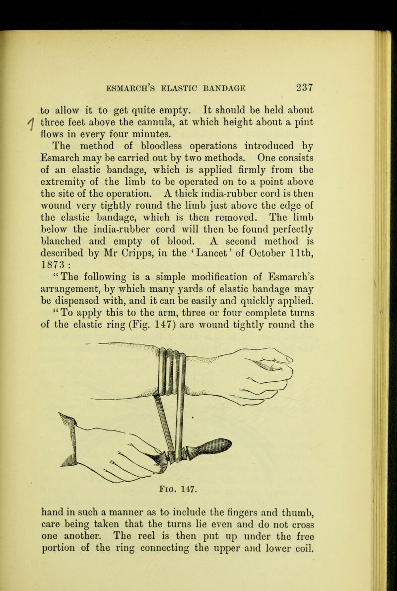 to allow it to get quite empty. It should be held about /J three feet above the cannula, at which height about a pint flows in every four minutes. The method of bloodless operations introduced by Esmarch may be carried out by two methods. One consists of an elastic bandage, which is applied firmly from the extremity of the limb to be operated on to a point above the site of the operation. A thick india-rubber cord is then wound very tightly round the limb just above the edge of the elastic bandage, which is then removed. The limb below the india-rubber cord will then be found perfectly blanched and empty of blood. A second method is described by Mr Cripps, in the 'Lancet' of October 11th, 1873:  The following is a simple modification of Esmarch's arrangement, hy which many yards of elastic bandage may be dispensed with, and it can be easily and quickly applied.  To apply this to the arm, three or four complete turns of the elastic ring (Fig. 147) are wound tightly round the Fig. 147. hand in such a manner as to include the fingers and thumb, care being taken that the turns lie even and do not cross one another. The reel is then put up under the free portion of the ring connecting the upper and lower coil.