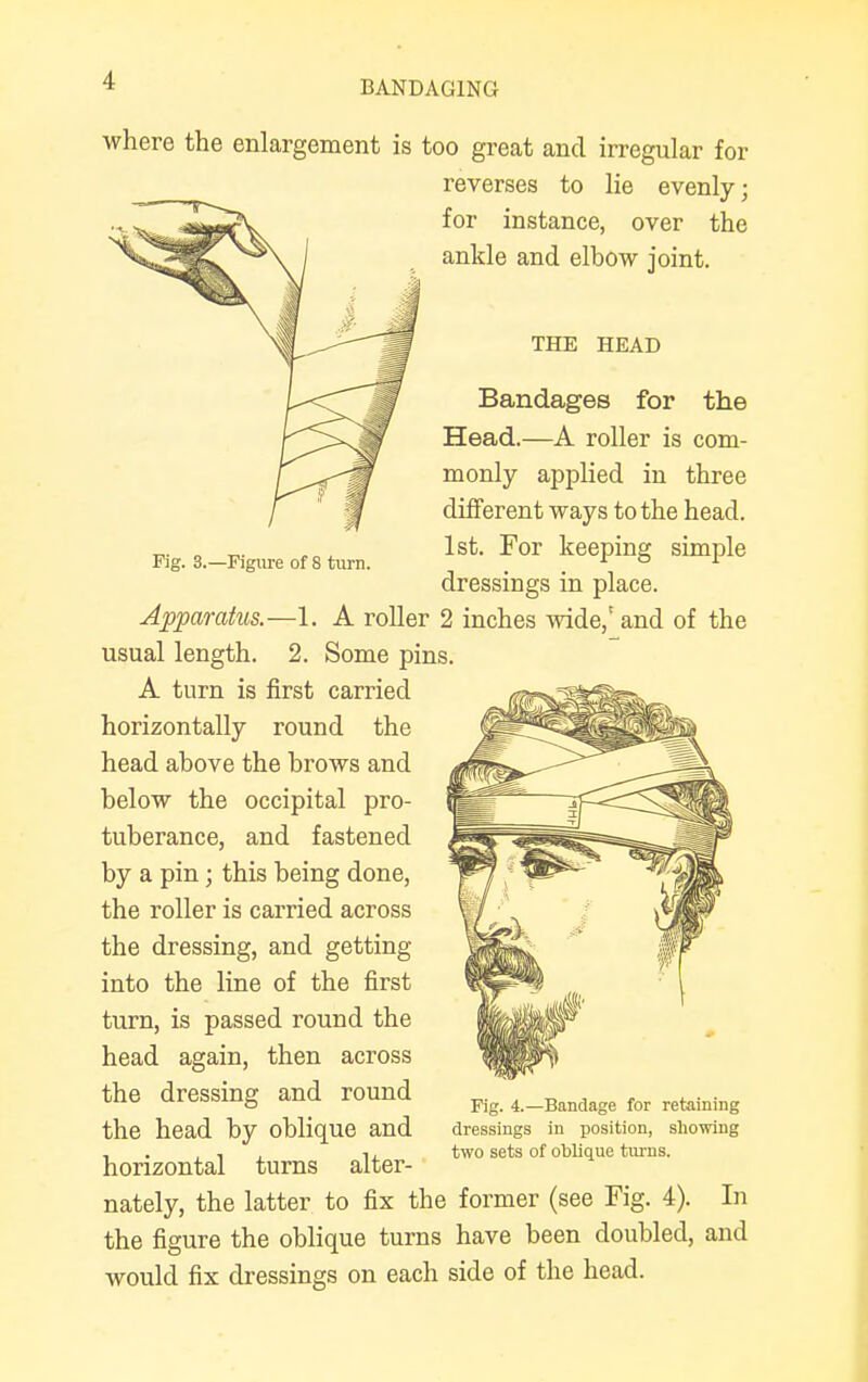 Fig. 3.—Figure of 8 turn. where the enlargement is too great and irregular for reverses to lie evenly; for instance, over the ankle and elbow joint. THE HEAD Bandages for the Head.—A roller is com- monly applied in three different ways to the head. 1st. For keeping simple dressings in place. Apparatus.—1. A roller 2 inches wide/and of the usual length. 2. Some pins. A turn is first carried horizontally round the head above the brows and below the occipital pro- tuberance, and fastened by a pin; this being done, the roller is carried across the dressing, and getting into the line of the first turn, is passed round the head again, then across the dressing and round the head by oblique and horizontal turns alter- nately, the latter to fix the former (see Fig. 4). In the figure the oblique turns have been doubled, and would fix dressings on each side of the head. Fig. 4.—Bandage for retaining dressings in position, showing two sets of oblique turns.
