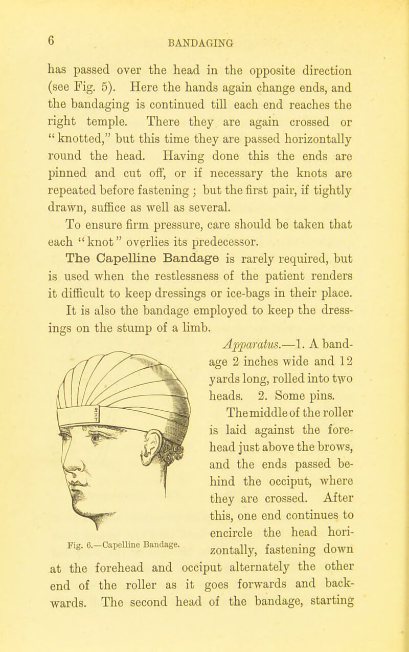 has passed over the head in the opposite direction (see Fig. 5). Here the hands again change ends, and the bandaging is continued till each end reaches the right temple. There they are again crossed or  knotted, but this time they are passed horizontally round the head. Having done this the ends are pinned and cut off, or if necessary the knots are repeated before fastening ; but the first pair, if tightly drawn, suffice as well as several. To ensure firm pressure, care should be taken that each knot overlies its predecessor. The Capelline Bandage is rarely required, but is used when the restlessness of the patient renders it difficult to keep dressings or ice-bags in their place. It is also the bandage employed to keep the dress- ings on the stump of a limb. Apparatus.—1. A band- age 2 inches wide and 12 yards long, rolled into two heads. 2. Some pins. The middle of the roller is laid against the fore- head just above the brows, and the ends passed be- hind the occiput, where they are crossed. After this, one end continues to encircle the head hori- zontally, fastening down at the forehead and occiput alternately the other end of the roller as it goes forwards and back- wards. The second head of the bandage, starting Fig. 6.—Capelline Bandage.