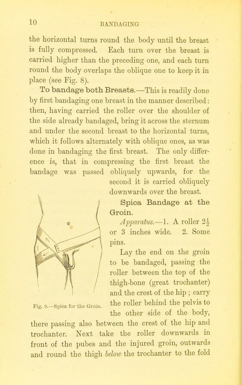 the horizontal turns round the hody until the breast is fully compressed. Each turn over the breast is carried higher than the preceding one, and each turn round the body overlaps the oblique one to keep it in place (see Fig. 8). To bandage both Breasts.—This is readily done by first bandaging one breast in the manner described: then, having carried the roller over the shoulder of the side already bandaged, bring it across the sternum and under the second breast to the horizontal turns, which it follows alternately with oblique ones, as was done in bandaging the first breast. The only differ- ence is, that in compressing the first breast the bandage was passed obliquely upwards, for the second it is carried obliquety downwards over the breast. Spica Bandage at the Groin. Apparatus.—1. A roller 2 \ or 3 inches wide. 2. Some pins. Lay the end on the groin to be bandaged, passing the roller between the top of the thigh-bone (great trochanter) and the crest of the hip; carry Fig. o-spica for the Groin, the roller behind the pelvis to the other side of the body, there passing also between the crest of the hip and trochanter. Next take the roller downwards in front of the pubes and the injured groin, outwards and round the thigh beloiv the trochanter to the fold