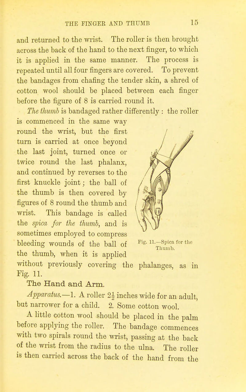 and returned to the wrist. The roller is then brought across the back of the hand to the next finger, to which it is applied in the same manner. The process is repeated until all four fingers are covered. To prevent the bandages from chafing the tender skin, a shred of cotton wool should be placed between each finger before the figure of 8 is carried round it. The thumb is bandaged rather differently : the roller is commenced in the same way round the wrist, but the first turn is carried at once beyond the last joint, turned once or twice round the last phalanx, and continued by reverses to the first knuckle joint; the ball of the thumb is then covered by figures of 8 round the thumb and wrist. This bandage is called the spica for the thumb, and is sometimes employed to compress bleeding wounds of the ball of Fig> n--sPica for th0 u Thumb. the thumb, when it is applied without previously covering the phalanges, as in Fig. 11. The Hand and Arm. Apparatus—-1. A roller 1\ inches wide for an adult, but narrower for a child. 2. Some cotton wool. A little cotton wool should be placed in the palm before applying the roller. The bandage commences with two spirals round the wrist, passing at the back of the wrist from the radius to the ulna. The roller is then carried across the back of the hand from the