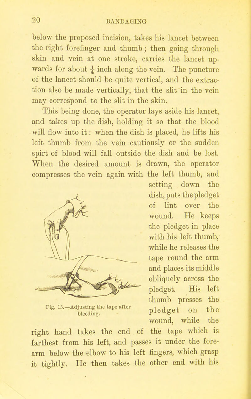 below the proposed incision, takes his lancet between the right forefinger and thumb; then going through skin and vein at one stroke, carries the lancet up- wards for about | inch along the vein. The puncture of the lancet should be quite vertical, and the extrac- tion also be made vertically, that the slit in the vein may correspond to the slit in the skin. This being done, the operator lays aside his lancet, and takes up the dish, holding it so that the blood will flow into it: when the dish is placed, he lifts his left thumb from the vein cautiously or the sudden spirt of blood will fall outside the dish and be lost. When the desired amount is drawn, the operator compresses the vein again with the left thumb, and setting down the dish, puts the pledget of lint over the wound. He keeps the pledget in place with his left thumb, while he releases the tape round the arm and places its middle obliquely across the pledget. His left thumb presses the pledget on the wound, while the right hand takes the end of the tape which is farthest from his left, and passes it under the fore- arm below the elbow to his left fingers, which grasp it tightly. He then takes the other end with his Fig. 15.—Adjusting the tape after bleeding.