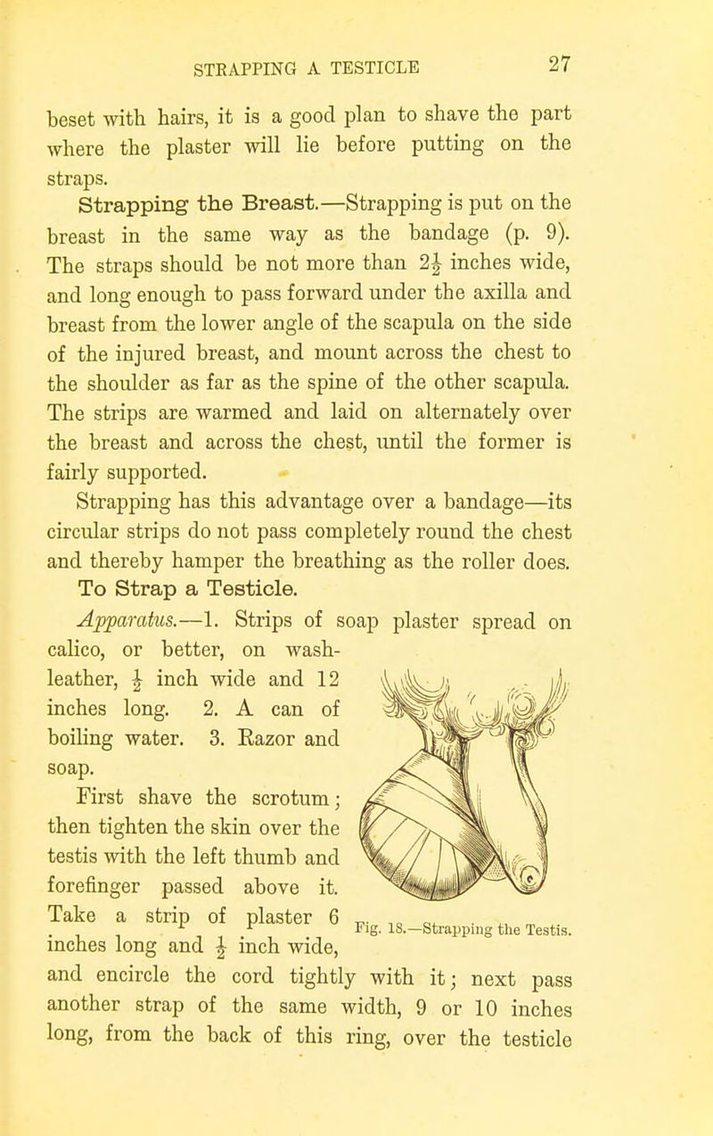STRAPPING A TESTICLE beset with hairs, it is a good plan to shave the part where the plaster will lie before putting on the straps. Strapping the Breast.—Strapping is put on the breast in the same way as the bandage (p. 9). The straps should be not more than 2J inches wide, and long enough to pass forward under the axilla and breast from the lower angle of the scapula on the side of the injured breast, and mount across the chest to the shoulder as far as the spine of the other scapula. The strips are warmed and laid on alternately over the breast and across the chest, until the former is fairly supported. Strapping has this advantage over a bandage—its circular strips do not pass completely round the chest and thereby hamper the breathing as the roller does. To Strap a Testicle. Apparatus.—1. Strips of soap plaster spread on calico, or better, on wash- inches long and \ inch wide, and encircle the cord tightly with it; next pass another strap of the same width, 9 or 10 inches long, from the back of this ring, over the testicle leather, \ inch wide and 12 inches long. 2. A can of boiling water. 3. Eazor and soap. First shave the scrotum; then tighten the skin over the testis with the left thumb and forefinger passed above it. Take a strip of plaster 6 Fig. 18.—Strapping the Testis.