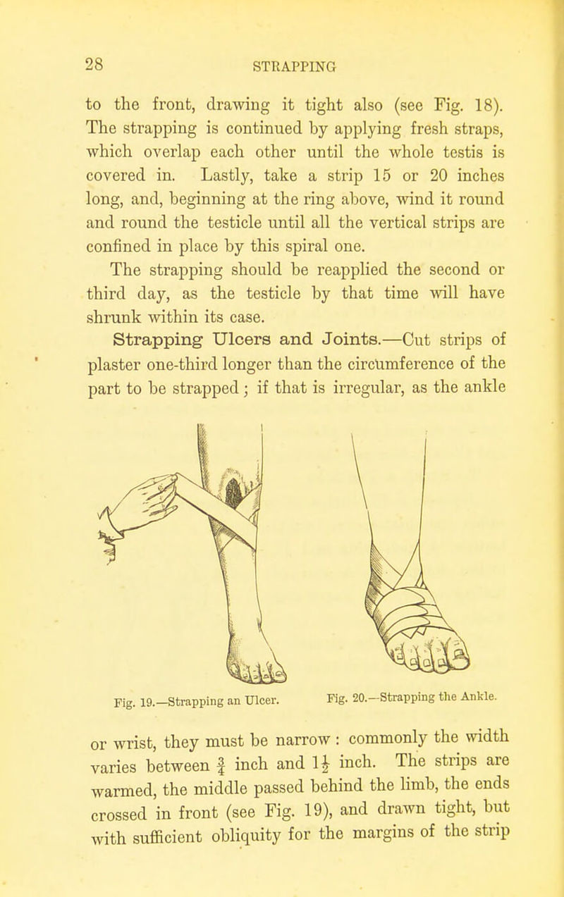 to the front, drawing it tight also (see Fig. 18). The strapping is continued by applying fresh straps, which overlap each other until the whole testis is covered in. Lastly, take a strip 15 or 20 inches long, and, beginning at the ring above, wind it round and round the testicle until all the vertical strips are confined in place by this spiral one. The strapping should be reapplied the second or third day, as the testicle by that time will have shrunk within its case. Strapping Ulcers and Joints.—Cut strips of plaster one-third longer than the circumference of the part to be strapped; if that is irregular, as the ankle Fig. 19.-Strapping an Ulcer. Fig. 20.-Strapping the Ankle. or wrist, they must be narrow : commonly the width varies between f inch and 1J inch. The strips are warmed, the middle passed behind the limb, the ends crossed in front (see Fig. 19), and drawn tight, but with sufficient obliquity for the margins of the strip