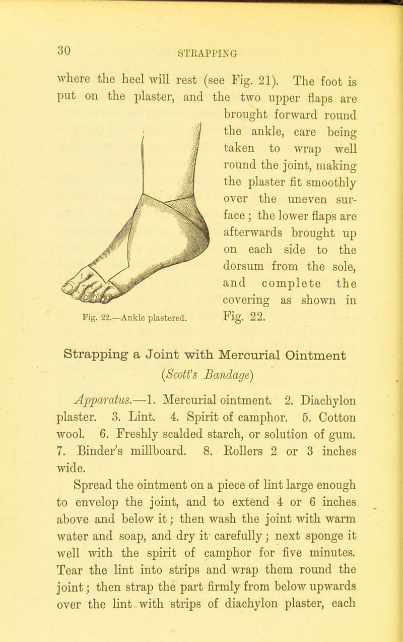 STRAP 1'IN G where the heel will rest (see Fig. 21). The foot is put on the plaster, and the two upper flaps are brought forward round the ankle, care being taken to wrap well round the joint, making the plaster fit smoothly over the uneven sur- face ; the lower flaps are afterwards brought up on each side to the dorsum from the sole, and complete the covering as shown in Fig. 22.—Ankle plastered. Fig. 22. Strapping a Joint with Mercurial Ointment (Scott's Bandage) Apparatus.—1. Mercurial ointment. 2. Diachylon plaster. 3. Lint. 4. Spirit of camphor. 5. Cotton wool. 6. Freshly scalded starch, or solution of gum. 7. Binder's millboard. 8. Eollers 2 or 3 inches wide. Spread the ointment on a piece of lint large enough to envelop the joint, and to extend 4 or 6 inches above and below it; then wash the joint with warm water and soap, and dry it carefully; next sponge it well with the spirit of camphor for five minutes. Tear the lint into strips and wrap them round the joint; then strap the part firmly from below upwards over the lint with strips of diachylon plaster, each
