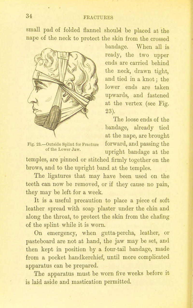 small pad of folded flannel should be placed at the nape of the neck to protect the skin from the crossed ^-^^ bandage. When all is temples, are pinned or stitched firmly together on the brows, and to the upright band at the temples. The ligatures that may have been used on the teeth can now be removed, or if they cause no pain, they may be left for a week. It is a useful precaution to place a piece of soft leather spread with soap plaster under the chin and along the throat, to protect the skin from the chafing of the splint while it is worn. On emergency, when gntta-percha, leather, or pasteboard are not at hand, the jaw may be set, and then kept in position by a four-tail bandage, made from a pocket handkerchief, until more complicated apparatus can be prepared. The apparatus must be worn five weeks before it is laid aside and mastication permitted. The loose ends of the bandage, already tied at the nape, are brought forward, and passing the upright bandage at the ready, the two upper ends are carried behind the neck, drawn tight, and tied in a knot; the lower ends are taken upwards, and fastened at the vertex (see Fig. 23). Fig. 23.—Outside Splint for Fracture of the Lower Jaw.