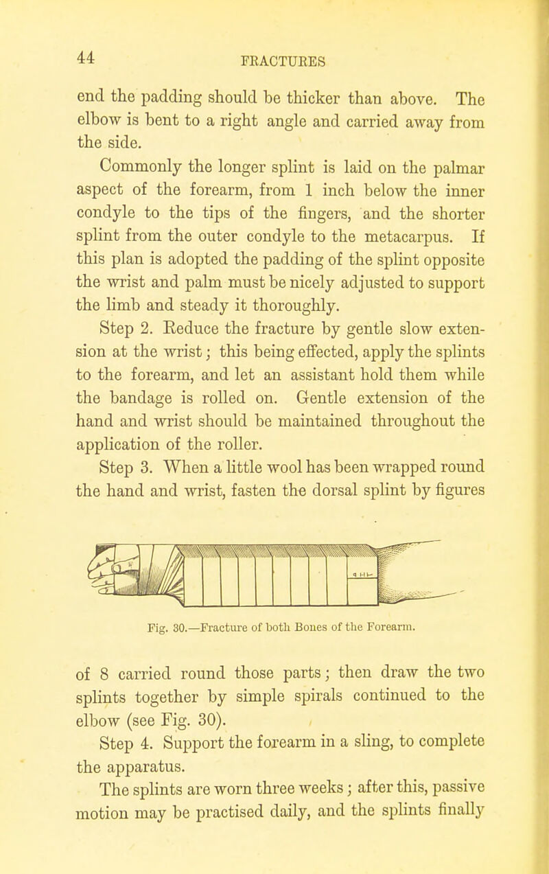 end the padding should be thicker than above. The elbow is bent to a right angle and carried away from the side. Commonly the longer splint is laid on the palmar aspect of the forearm, from 1 inch below the inner condyle to the tips of the fingers, and the shorter splint from the outer condyle to the metacarpus. If this plan is adopted the padding of the splint opposite the wrist and palm must be nicely adjusted to support the limb and steady it thoroughly. Step 2. Eeduce the fracture by gentle slow exten- sion at the wrist; this being effected, apply the splints to the forearm, and let an assistant hold them while the bandage is rolled on. Gentle extension of the hand and wrist should be maintained throughout the application of the roller. Step 3. When a little wool has been wrapped round the hand and wrist, fasten the dorsal splint by figures > Uli Fig. 30.—Fracture of both Bones of the Forearm. of 8 carried round those parts; then draw the two splints together by simple spirals continued to the elbow (see Fig. 30). Step 4. Support the forearm in a sling, to complete the apparatus. The splints are worn three weeks; after this, passive motion may be practised daily, and the splints finally