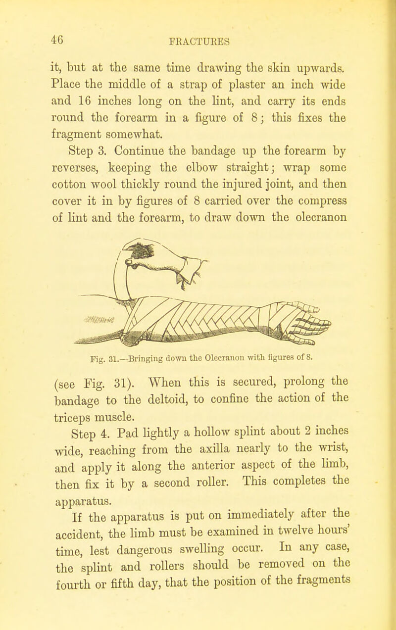 it, but at the same time drawing the skin upwards. Place the middle of a strap of plaster an inch wide and 16 inches long on the lint, and carry its ends round the forearm in a figure of 8; this fixes the fragment somewhat. Step 3. Continue the bandage up the forearm by reverses, keeping the elbow straight; wrap some cotton wool thickly round the injured joint, and then cover it in by figures of 8 carried over the compress of lint and the forearm, to draw down the olecranon Fig. 31.—Bringing down the Olecranon with figures of S. (see Fig. 31). When this is secured, prolong the bandage to the deltoid, to confine the action of the triceps muscle. Step 4. Pad lightly a hollow splint about 2 inches wide, reaching from the axilla nearly to the wrist, and apply it along the anterior aspect of the limb, then fix it by a second roller. This completes the apparatus. If the apparatus is put on immediately after the accident, the limb must be examined in twelve hours' time, lest dangerous swelling occur. In any case, the splint and rollers should be removed on the fourth or fifth day, that the position of the fragments