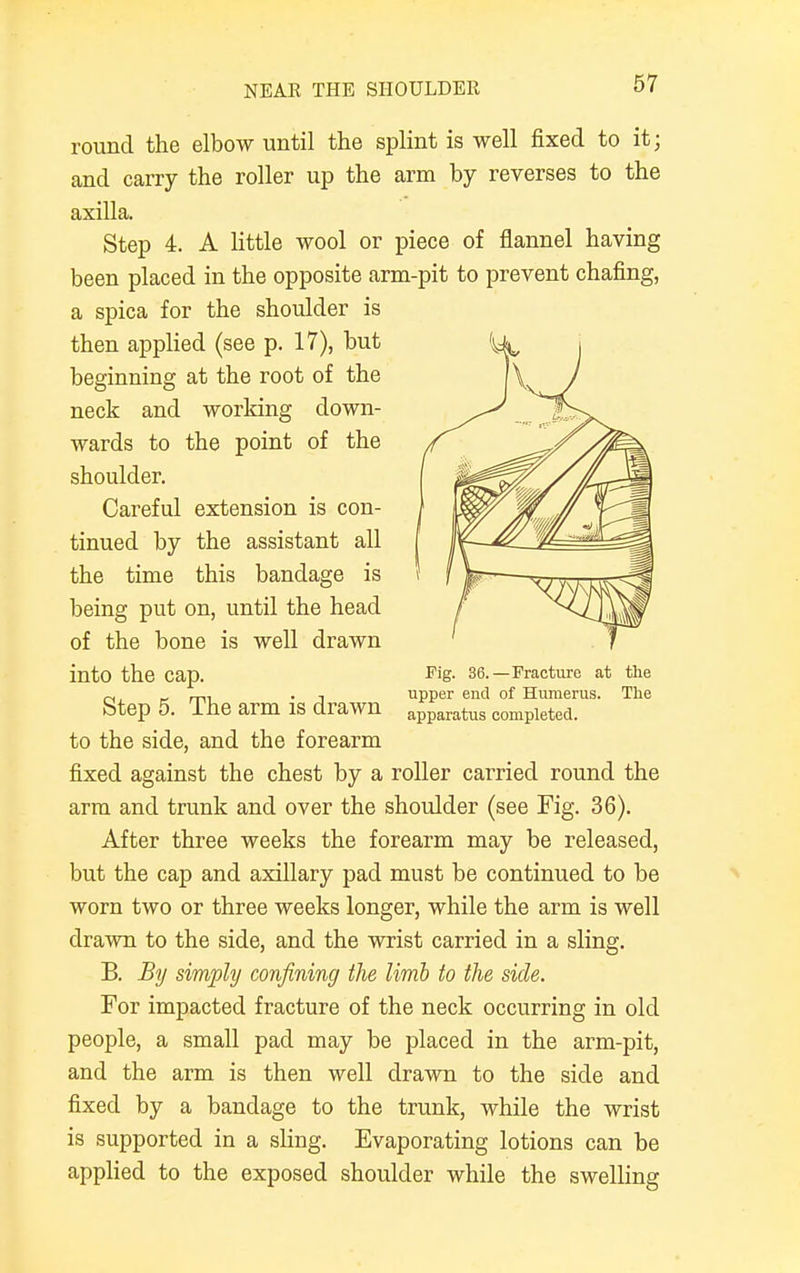 round the elbow until the splint is well fixed to it; and carry the roller up the arm by reverses to the axilla. Step 4. A little wool or piece of flannel having been placed in the opposite arm-pit to prevent chafing, a spica for the shoulder is then applied (see p. 17), but U j to the side, and the forearm fixed against the chest by a roller carried round the arm and trunk and over the shoulder (see Fig. 36). After three weeks the forearm may be released, but the cap and axillary pad must be continued to be worn two or three weeks longer, while the arm is well drawn to the side, and the wrist carried in a sling. B. By simply confining the limb to the side. For impacted fracture of the neck occurring in old people, a small pad may be placed in the arm-pit, and the arm is then well drawn to the side and fixed by a bandage to the trunk, while the wrist is supported in a sling. Evaporating lotions can be applied to the exposed shoulder while the swelling Careful extension is con- tinued by the assistant all the time this bandage is being put on, until the head of the bone is well drawn into the cap. beginning at the root of the neck and worldng down- wards to the point of the shoulder. Step 5. The arm is drawn Pig. 36.—Fracture at the upper end of Humerus. The apparatus completed.
